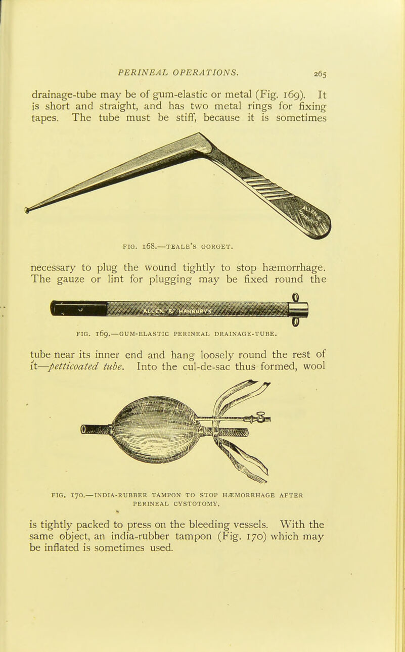drainage-tube may be of gum-elastic or metal (Fig. 169). It is short and straight, and has two metal rings for fixing tapes. The tube must be stiff, because it is sometimes FIG. 168.—TEALE's gorget. necessary to plug the wound tightly to stop haemorrhage. The gauze or lint for plugging may be fixed round the FIG. 169.—GUM-ELASTIC PERINEAL DRAINAGE-TUBE. tube near its inner end and hang loosely round the rest of it—petticoated tube. Into the cul-de-sac thus formed, wool FIG. 170.— INDIA-RUBBER TAMPON TO STOP HEMORRHAGE AFTER PERINEAL CYSTOTOMY. is tightly packed to press on the bleeding vessels. With the same object, an india-rubber tampon (Fig. 170) which may be inflated is sometimes used.