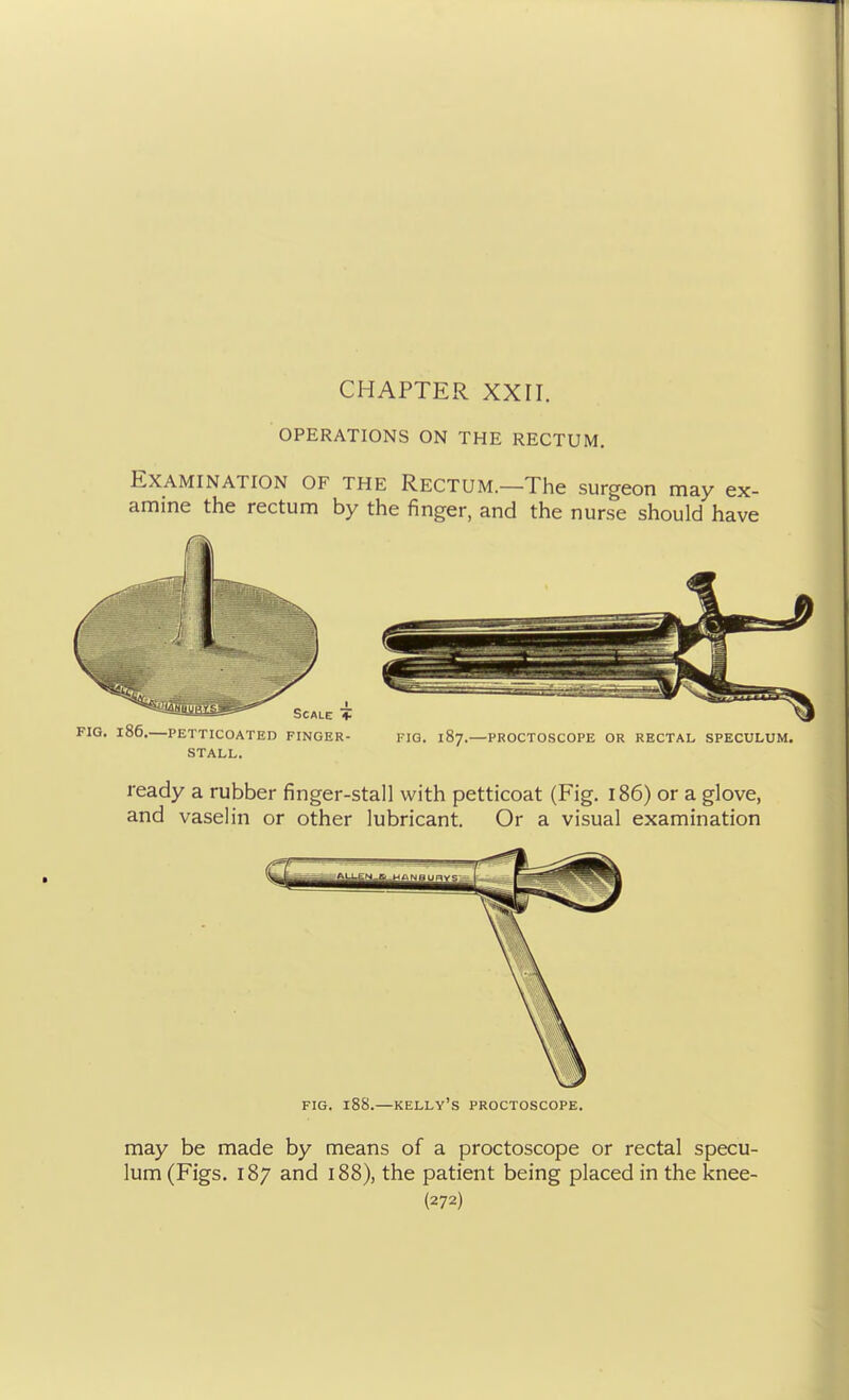 CHAPTER XXri. OPERATIONS ON THE RECTUM. Examination of the Rectum.—The surgeon may ex- amine the rectum by the finger, and the nurse should have 86.—PETTICOATED FINGER- FIG. 187.—PROCTOSCOPE OR RECTAL SPECULUM. STALL. ready a rubber finger-stall with petticoat (Fig. i86) or a glove, and vaselin or other lubricant. Or a visual examination FIG. 188.—Kelly's proctoscope. may be made by means of a proctoscope or rectal specu- lum (Figs. 187 and i88), the patient being placed in the knee- {272)