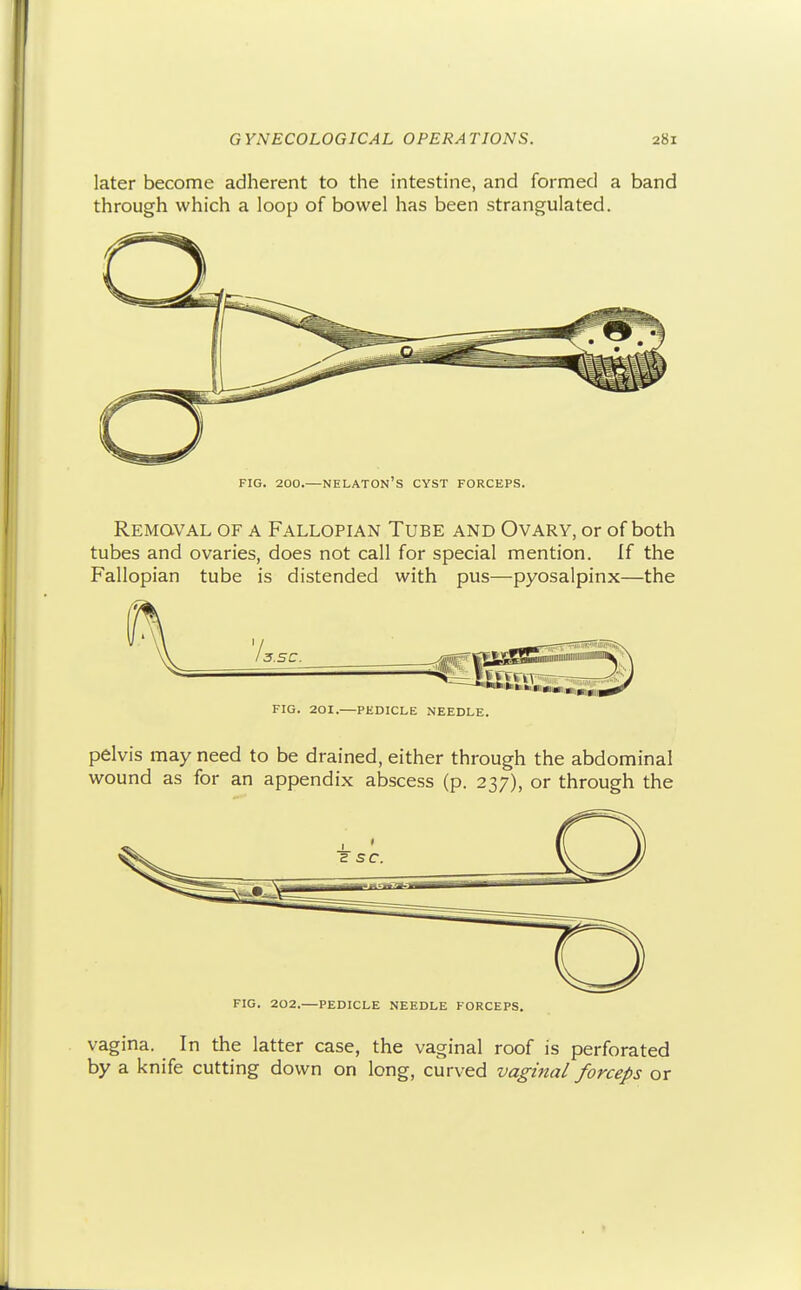later become adherent to the intestine, and formed a band through which a loop of bowel has been strangulated. FIG. 200.—NELATON'S CYST FORCEPS. Removal of a Fallopian Tube and Ovary, or of both tubes and ovaries, does not call for special mention. If the Fallopian tube is distended with pus—pyosalpinx—the FIG. 201.—PEDICLE NEEDLE. pelvis may need to be drained, either through the abdominal wound as for an appendix abscess (p. 237), or through the FIG. 202.—PEDICLE NEEDLE FORCEPS. vagina. In the latter case, the vaginal roof is perforated by a knife cutting down on long, curved vaginal forceps or