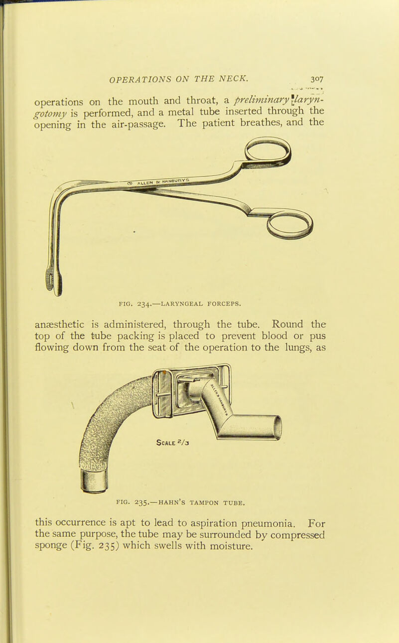J Operations on the mouth and throat, a preliininary\laryn- gotoviv is performed, and a metal tube inserted through the opening in the air-passage. The patient breathes, and the FIG. 234.—LARYNGEAL FORCEPS. anaesthetic is administered, through the tube. Round the top of the tube packing is placed to prevent blood or pus flowing down from the seat of the operation to the lungs, as FIG. 235.—HAHN's tampon TUBE. this occurrence is apt to lead to aspiration pneumonia. For the same purpose, the tube may be surrounded by compressed sponge (Fig. 235) which swells with moisture.