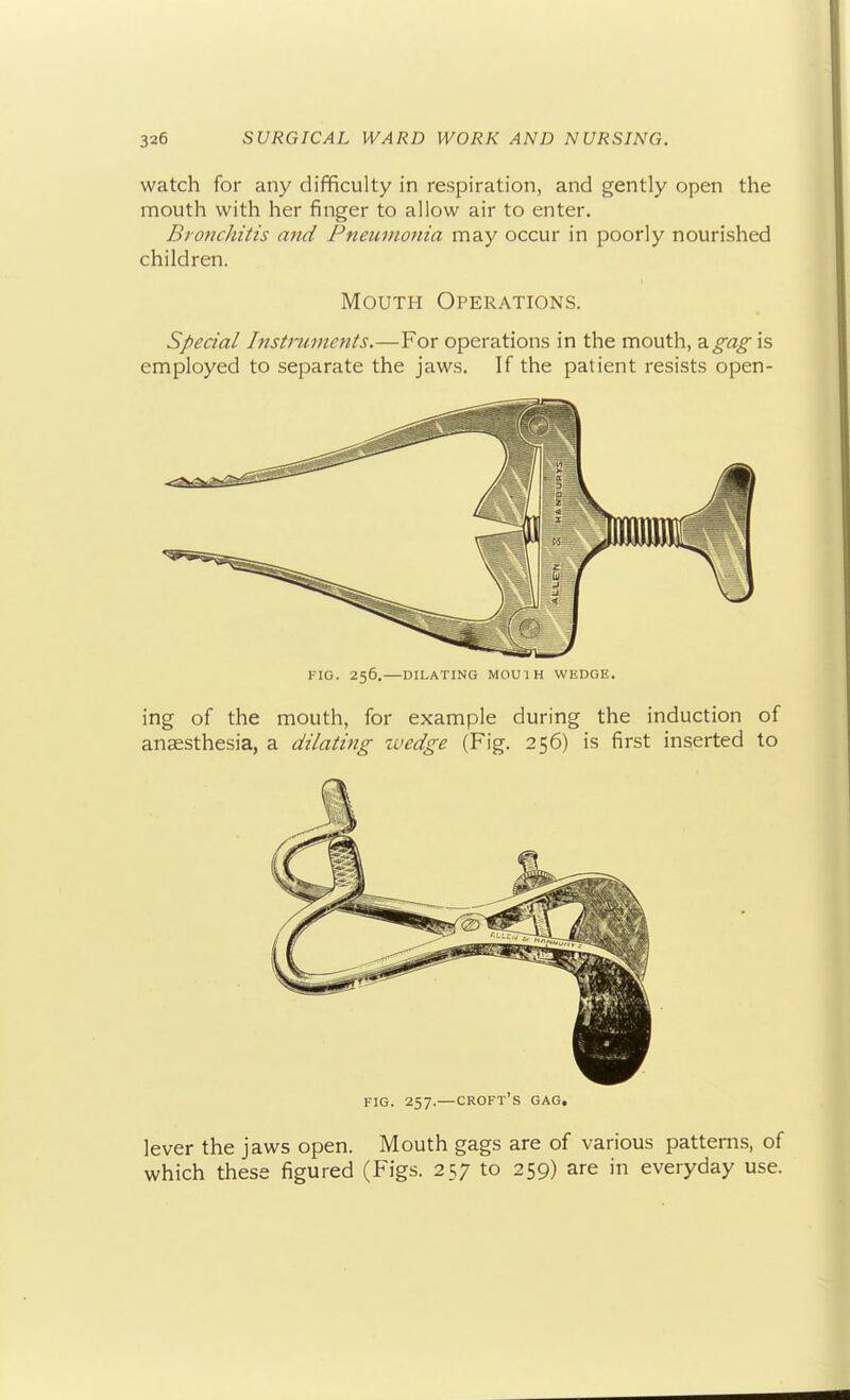 watch for any difficulty in respiration, and gently open the mouth with her finger to allow air to enter. Bronchitis ajid Pneumonia may occur in poorly nourished children. Mouth Operations. Special Instruments.—For operations in the mouth, a,gag is employed to separate the jaws. If the patient resists open- FIG. 256.—DILATING MOUIH WEDGE. ing of the mouth, for example during the induction of anaesthesia, a dilating zvedge (Fig. 256) is first inserted to FIG. 257.—croft's gag. lever the jaws open. Mouth gags are of various patterns, of which these figured (Figs. 257 to 259) are in everyday use.