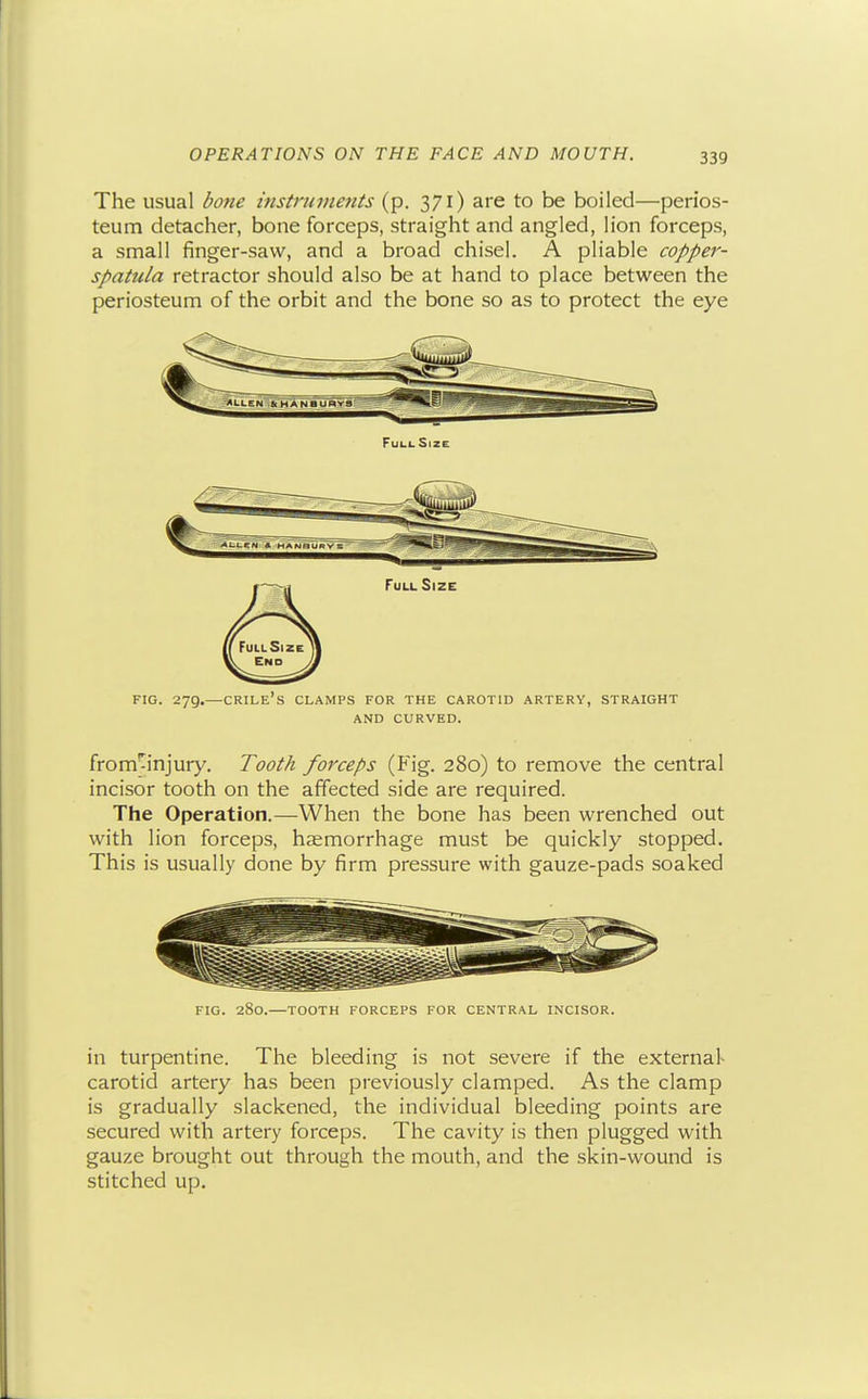 The usual done instruments (p. 371) are to be boiled—perios- teum detacher, bone forceps, straight and angled, lion forceps, a small finger-saw, and a broad chisel. A pliable copper- spatula retractor should also be at hand to place between the periosteum of the orbit and the bone so as to protect the eye FIG. 279.—crile's clamps for the carotid artery, straight AND CURVED. from'^injury. Tooth forceps (Fig. 280) to remove the central incisor tooth on the affected side are required. The Operation.—When the bone has been wrenched out with lion forceps, haemorrhage must be quickly stopped. This is usually done by firm pressure with gauze-pads soaked FIG. 280.—TOOTH FORCEPS FOR CENTRAL INCISOR. in turpentine. The bleeding is not severe if the external- carotid artery has been previously clamped. As the clamp is gradually slackened, the individual bleeding points are secured with artery forceps. The cavity is then plugged with gauze brought out through the mouth, and the skin-wound is stitched up.