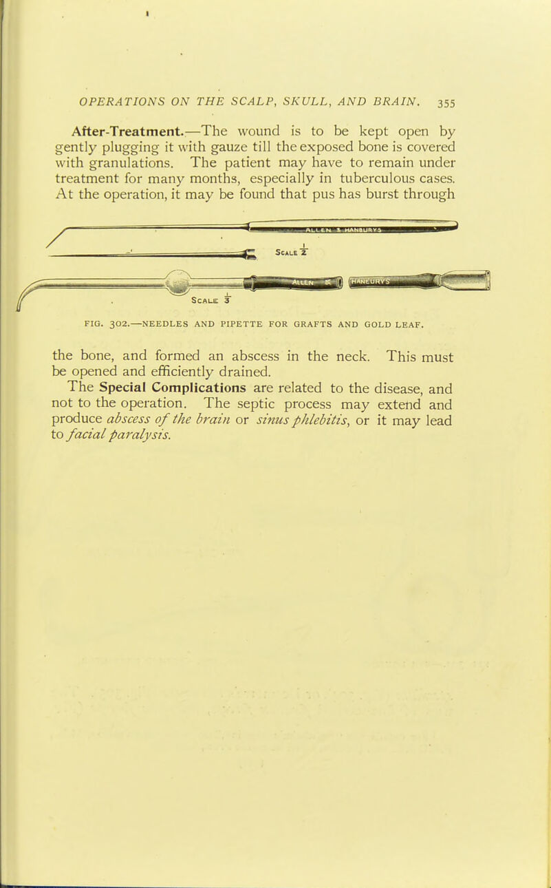 After-Treatment.;—The wound is to be kept open by gently plugging it with gauze till the exposed bone is covered with granulations. The patient may have to remain under treatment for many months, especially in tuberculous cases. At the operation, it may be found that pus has burst through FIG. 302.—NEEDLES AND PIPETTE FOR GRAFTS AND GOLD LEAF. the bone, and formed an abscess in the neck. This must be opened and efficiently drained. The Special Complications are related to the disease, and not to the operation. The septic process may extend and produce abscess of the brain or sinus phlebitis, or it may lead to facial paralysis.