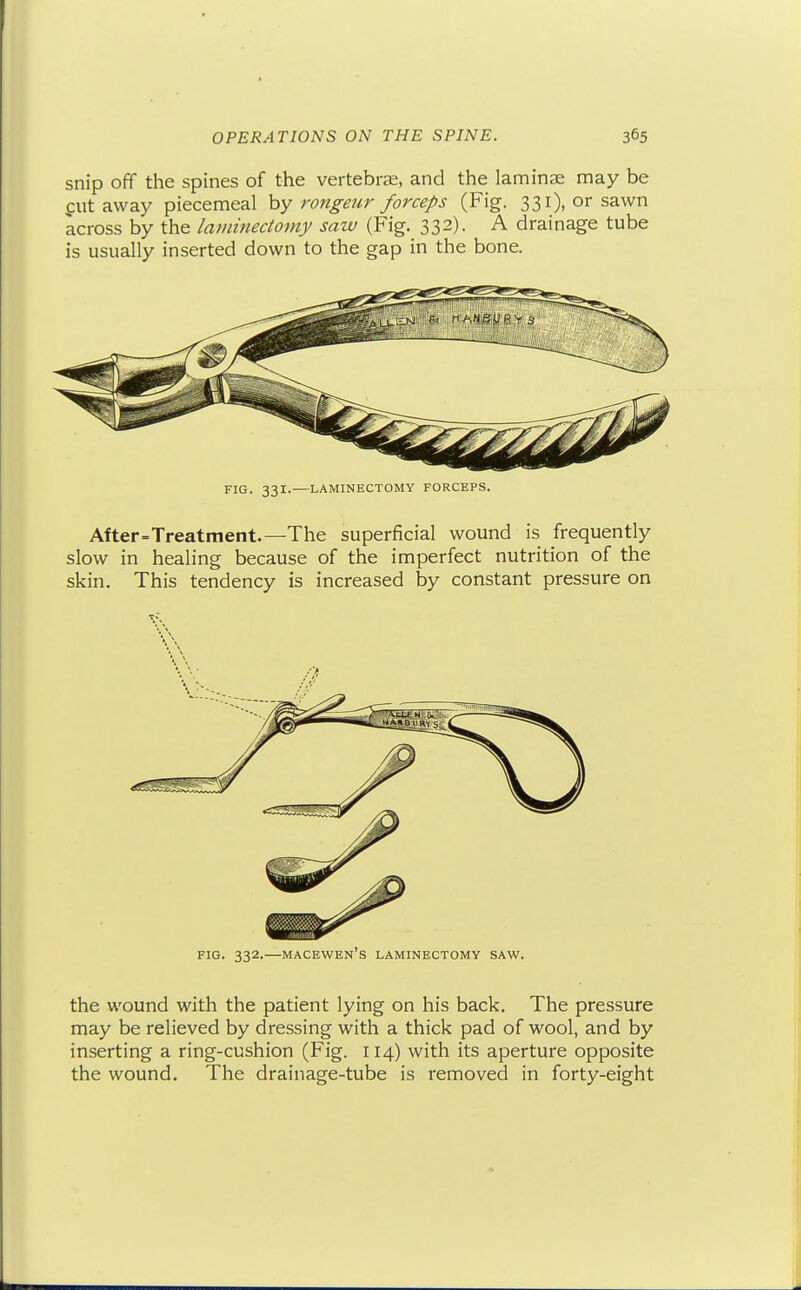 snip off the spines of the vertebrae, and the laminae may be flit away piecemeal rongeur forceps (Fig. 331), or sawn across by the laminectomy saw (Fig. 332). A drainage tube is usually inserted down to the gap in the bone. FIG. 331. LAMINECTOMY FORCEPS. After=Treatment.—The superficial wound is frequently slow in healing because of the imperfect nutrition of the skin. This tendency is increased by constant pressure on FIG. 332.—macewen's laminectomy saw. the wound with the patient lying on his back. The pressure may be relieved by dressing with a thick pad of wool, and by inserting a ring-cushion (Fig. 114) with its aperture opposite the wound. The drainage-tube is removed in forty-eight