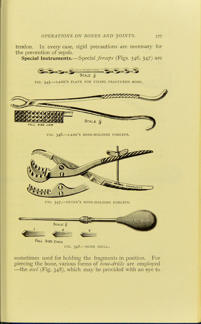 tendon. In every case, rigid precautions are necessary for the prevention of sepsis. Special Instruments.—Special forceps (Figs. 346, 347) are Scale g FIG. 345.—lane's plate FOR FIXING FRACTURED BONE. fULL SIZE JAW FIG. 346.—lane's bone-holding FORCEPS. FIG. 347.—PETER S BONE-HOLDING FORCEPS. Full Size Ends FIG. 348. BONE DRILL. sometimes used for holding the fragments in position. For piercing the bone, various forms of bone-drills are employed —the awl (Fig. 348), which may be provided with an eye to