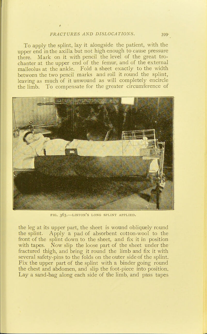 To apply the splint, lay it alongside the patient, with the upper end in the axilla but not high enough to cause pressure there. Mark on it with pencil the level of the great tro- chanter at the upper end of the femur, and of the external malleolus at the ankle. Fold a sheet exactly to the width between the two pencil marks and roll it round the splint, leaving as much of it unwound as will completely encircle the limb. To compensate for the greater circumference of FIG. 363.—LISTON's long SPLINT APPLIED. the leg at its upper part, the sheet is wound obliquely round the splint. Apply a pad of absorbent cotton-wool to the front of the splint down to the sheet, and fix it in position with tapes. Now slip the loose part of the sheet under the fractured thigh, and bring it round the limb and fix it with several safety-pins to the folds on the outer side of the splint. Fix the upper part of the splint with a binder going round the chest and abdomen, and slip the foot-piece into position. Lay a sand-bag along each side of the limb, and pass tapes-