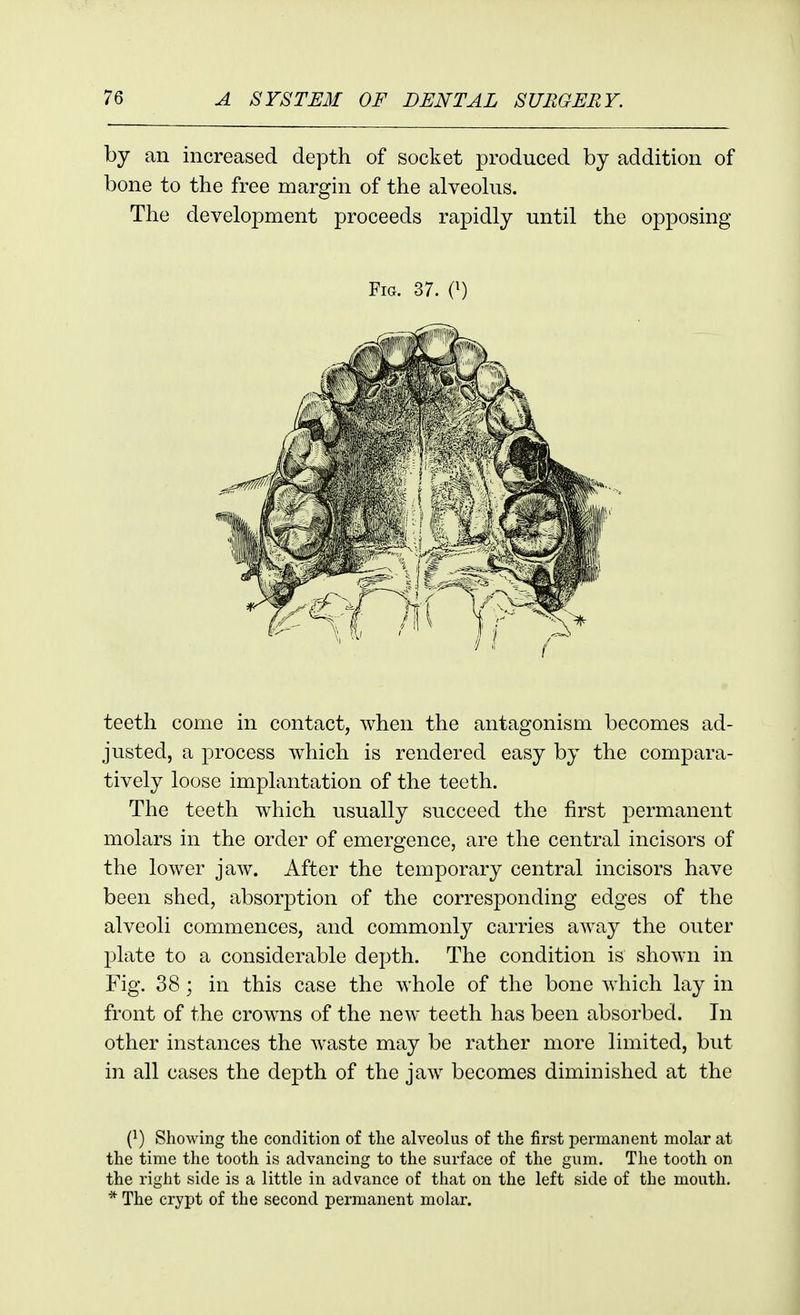by an increased depth of socket produced by addition of bone to the free margin of the alveolus. The development proceeds rapidly until the opposing teeth come in contact, when the antagonism becomes ad- justed, a process which is rendered easy by the compara- tively loose implantation of the teeth. The teeth which usually succeed the first permanent molars in the order of emergence, are the central incisors of the lower jaw. After the temporary central incisors have been shed, absorption of the corresponding edges of the alveoli commences, and commonly carries away the outer plate to a considerable depth. The condition is shown in Fig. 38; in this case the whole of the bone which lay in front of the crowns of the new teeth has been absorbed. In other instances the waste may be rather more limited, but in all cases the depth of the jaw becomes diminished at the (^) Showing the condition of the alveolus of the first permanent molar at the time the tooth is advancing to the surface of the gum. The tooth on the right side is a little in advance of that on the left side of the mouth. * The crypt of the second permanent molar. Fig. 37. C)
