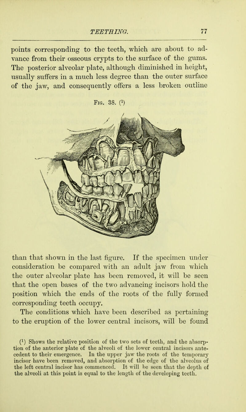 points corresponding to the teeth, which are about to ad- vance from their osseous crypts to the surface of the gums. The posterior alveolar plate, although diminished in height, usually suffers in a much less degree than the outer surface of the jaw, and consequently offers a less broken outline Fig. 38. {^) than that shown in the last figure. If the specimen under consideration be compared with an adult jaw from which the outer alveolar plate has been removed, it will be seen that the open bases of the two advancing incisors hold the position Avhich the ends of the roots of the fully formed corresponding teeth occupy. The conditions w^hich have been described as pertaining to the eruption of the lower central incisors, will be found {}) Shows the relative position of the two sets of teeth, and the absorp- tion of the anterior plate of the alveoli of the loAver central incisors ante- cedent to their emergence. In the npper jaw the roots of the temporary incisor have been removed, and absoi-ption of the edge of the alveolus of the left central incisor has commenced. It will be seen that the depth of the alveoli at this point is equal to the length of the developing teeth.