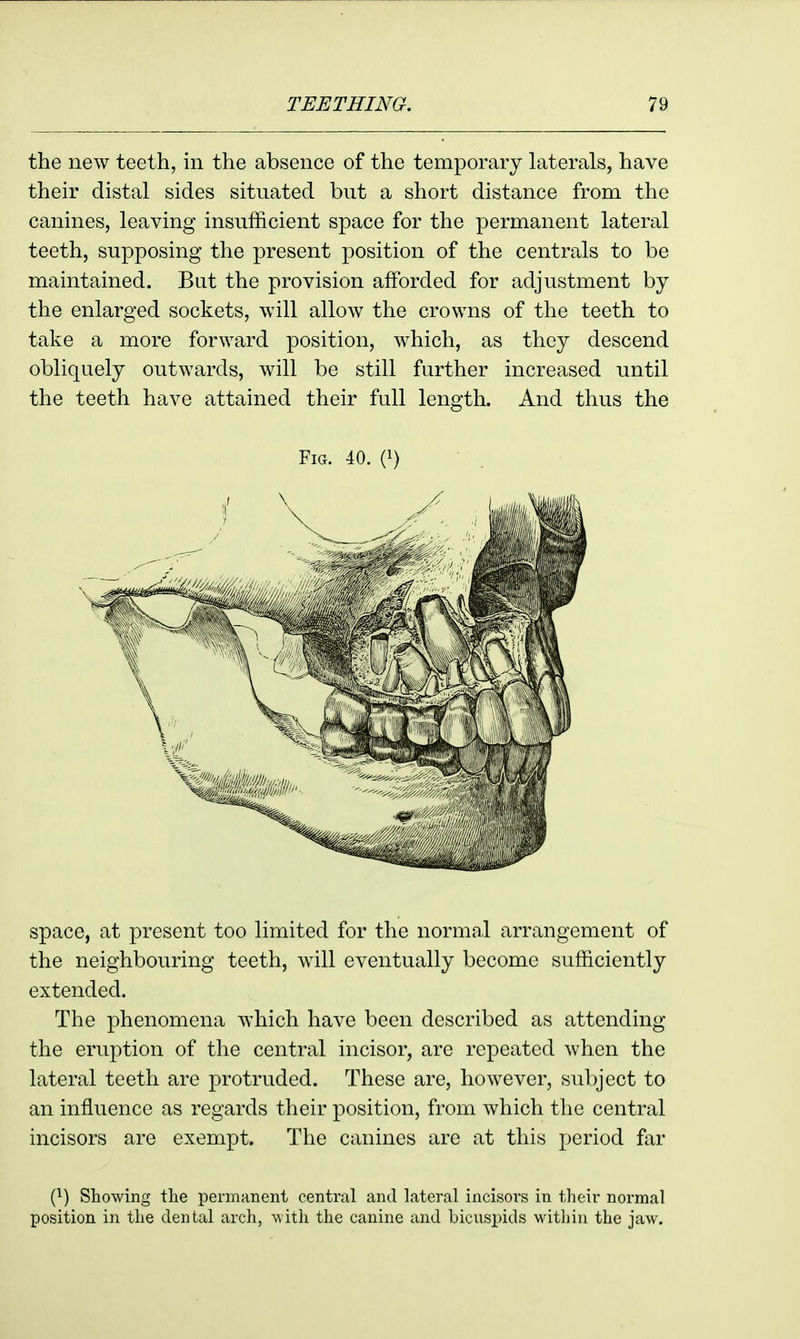 the new teeth, in the absence of the temporary laterals, have their distal sides situated but a short distance from the canines, leaving insufficient space for the permanent lateral teeth, supposing the present position of the centrals to be maintained. But the provision afforded for adjustment by the enlarged sockets, will allow the crowns of the teeth to take a more forward position, which, as they descend obliquely outwards, will be still further increased until the teeth have attained their full length. And thus the Fig. 40. i}) space, at present too limited for the normal arrangement of the neighbouring teeth, wdll eventually become sufficiently extended. The phenomena which have been described as attending the eruption of the central incisor, are repeated when the lateral teeth are protruded. These are, however, subject to an influence as regards their position, from which the central incisors are exempt. The canines are at this period far (1) Showing the permanent central and lateral incisors in their normal position in the dental arch, with the canine and bicusi)ids within the jaw.