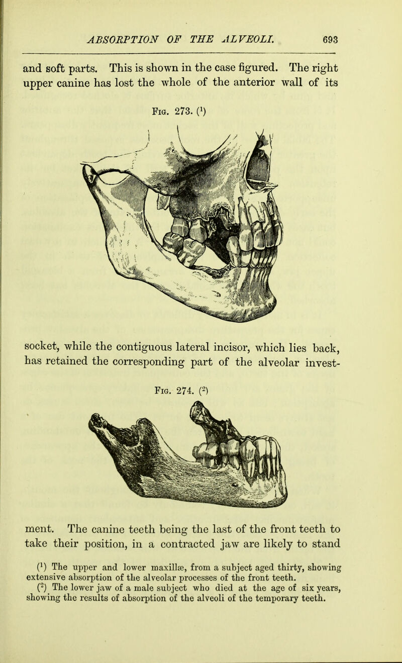 and soft parts. This is shown in the case figured. The right upper canine has lost the whole of the anterior wall of its Fig. 273. {^) socket, while the contiguous lateral incisor, which lies back, has retained the corresponding part of the alveolar invest- FiG. 274. (2) ment. The canine teeth being the last of the front teeth to take their position, in a contracted jaw are likely to stand {}) The upper and lower maxillfe, from a subject aged thirty, showing extensive absorption of the alveolar processes of the front teeth. (2) The lower jaw of a male subject who died at the age of six years, showing the results of absorption of the alveoli of the temporary teeth.