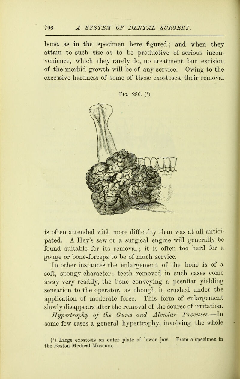 bone, as in the specimen here figured; and when they attain to such size as to be productive of serious incon- venience, which they rarely do, no treatment but excision of the morbid growth will be of any service. Owing to the excessive hardness of some of these exostoses, their removal Fig. 280. {}) is often attended with more difficulty than was at all antici- pated. A Hey's saw or a surgical engine will generally be found suitable for its removal; it is often too hard for a gouge or bone-forceps to be of much service. In other instances the enlargement of the bone is of a soft, spongy character: teeth removed in such cases come aw^ay very readily, the bone conveying a peculiar yielding sensation to the operator, as though it crushed under the application of moderate force. This form of enlargement slowly disappears after the removal of the source of irritation. Hypertrophy of the Gums and Alveolar Processes.—In some few cases a general hypertrophy, involving the whole (1) Large exostosis on outer plate of lower jaw. From a specimen in tbe Boston Medical Museum.