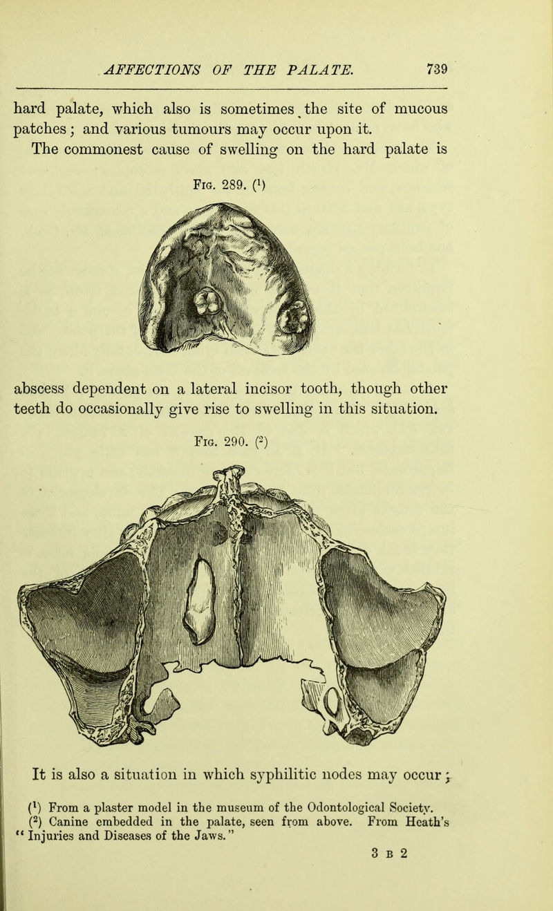 hard palate, which also is sometimes the site of mucous patches; and various tumours may occur upon it. The commonest cause of swelling on the hard palate is Fig. 289. (i) abscess dependent on a lateral incisor tooth, though other teeth do occasionally give rise to swelling in this situation. Fig. 290. P) It is also a situation in which syphilitic nodes may occur ^ {}) From a plaster model in the museum of the Odontological Society. (2) Canine embedded in the palate, seen from above. From Heath's  Injuries and Diseases of the Jaws. 3 B 2