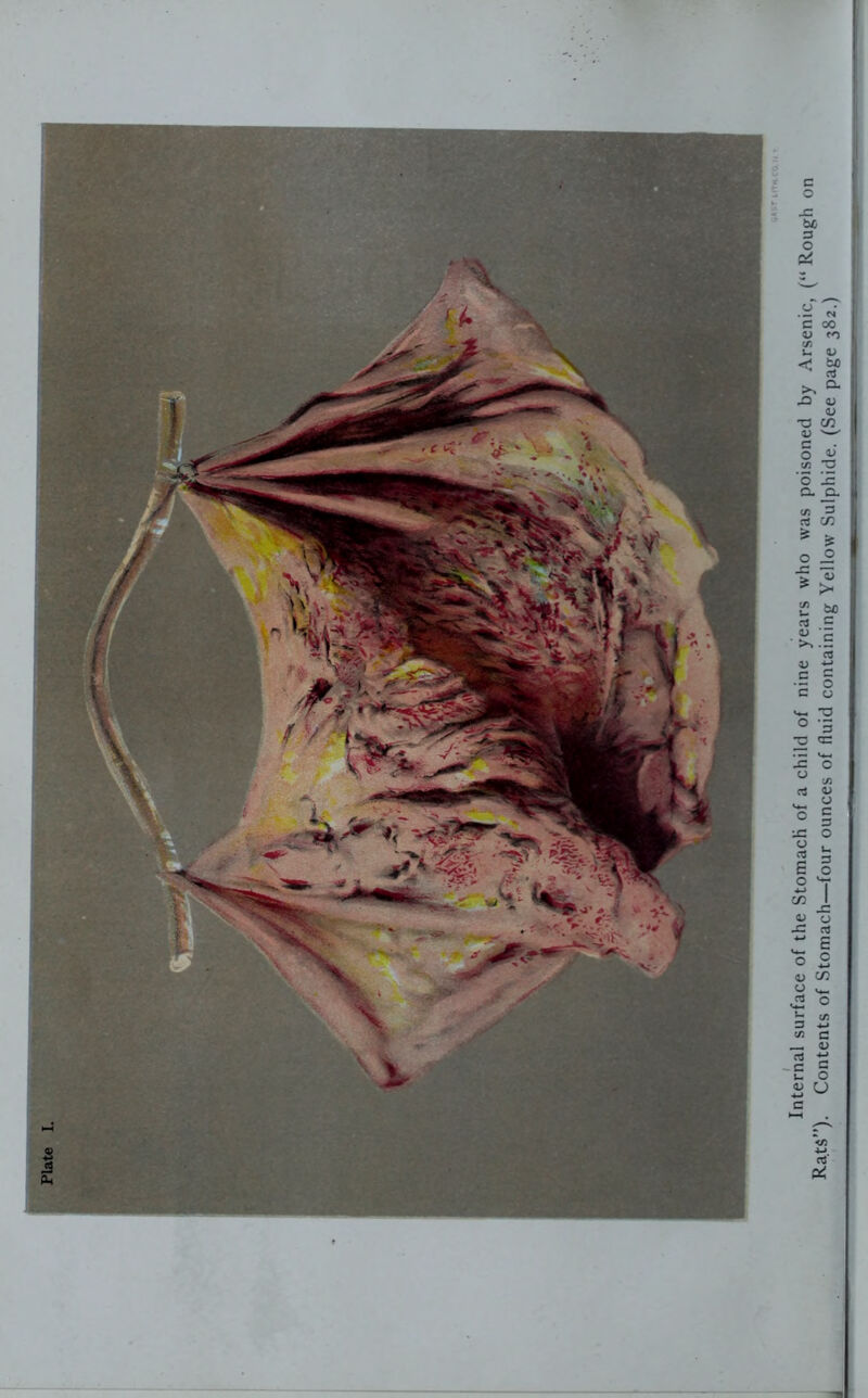 Plate Internal surface of the Stomach of a child of nine years who was poisoned by Arsenic, (“ Rough on Rats”). Contents of Stomach—four ounces of fluid containing Yellow Sulphide. (See page 382.)