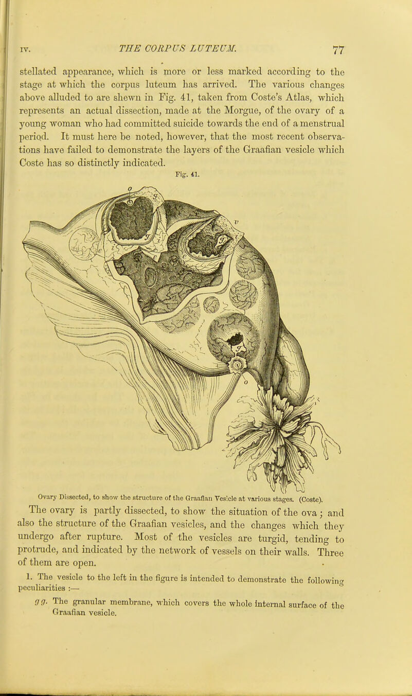 Ovary Dissected, to show the structure of the Graafian Vesicle at various stages. (Coste). The ovary is partly dissected, to show the situation of the ova; and also the structure of the Graafian vesicles, and the changes which the} undergo after rupture. Most of the vesicles are turgid, tending tc protrude, and indicated by the network of vessels on their walls. Three of them are open. 1. The vesicle to the left in the figure is intended to demonstrate the following peculiarities :— Oil. The granular membrane, which covers the whole internal surface of the Graafian vesicle. stellated appearance, which is more or less marked according to the stage at which the corpus luteum has arrived. The various changes above alluded to are shewn in Fig. 41, taken from Coste’s Atlas, which represents an actual dissection, made at the Morgue, of the ovary of a young woman who had committed suicide towards the end of a menstrual period. It must here be noted, however, that the most recent observa- tions have failed to demonstrate the layers of the Graafian vesicle which Coste has so distinctly indicated. Figr. 41.