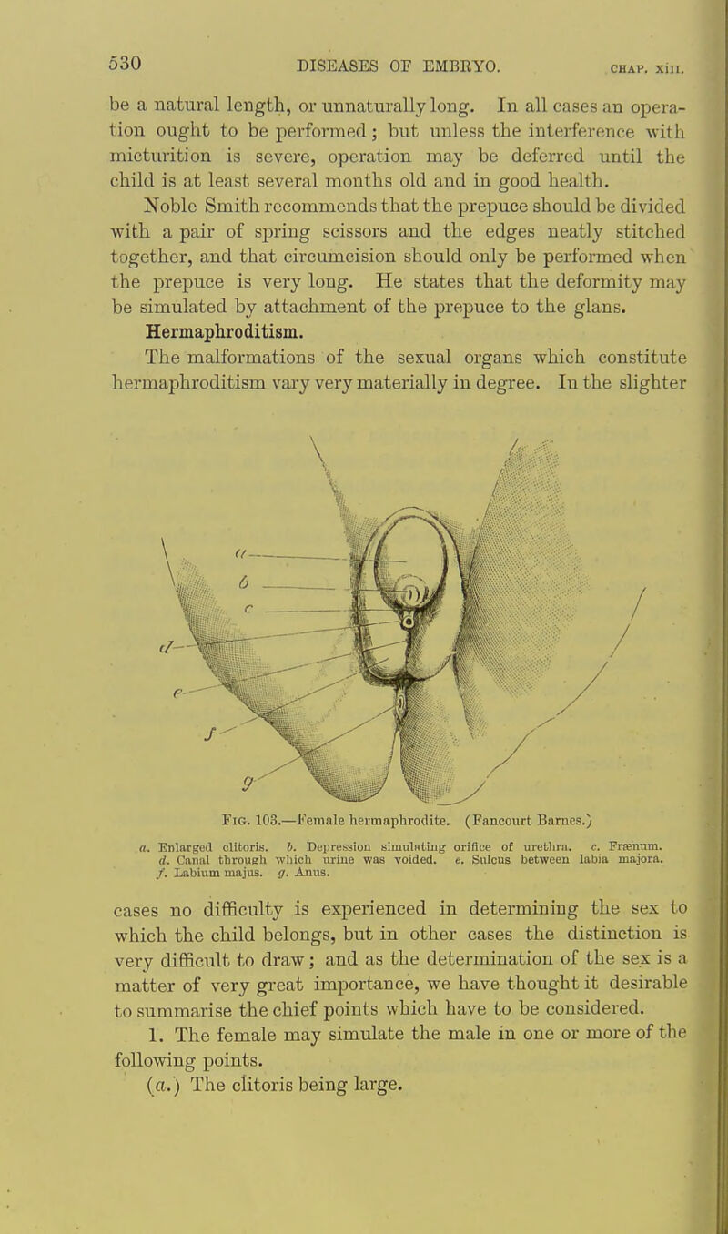 be a natural length, or unnaturally long. In all cases an opera- tion ought to be performed; but unless the interference with micturition is severe, operation may be deferred until the child is at least several months old and in good health. Noble Smith recommends that the prepuce should be divided with a pair of spring scissors and the edges neatly stitched together, and that circumcision should only be performed when the prepuce is very long. He states that the deformity may be simulated by attachment of the prepuce to the glans. Hermaphroditism. The malformations of the sexual organs which constitute hermaphroditism vary very materially in degree. In the slighter Fig. 103.—Female hermaphrodite. (Fancourt Barnes.) o. Enlarged clitoris. h. Depression simulntiiig orifice of uretiirn. c. Friemim. d. Canal tliroueli wliich iiriue was voided, e. Sulcus between labia majora. /. Labium majus. g. Anus. cases no difficulty is experienced in determining the sex to which the child belongs, but in other cases the distinction is very difficult to draw; and as the determination of the sex is a matter of very great importance, we have thought it desirable to summarise the chief points which have to be considered. 1. The female may simulate the male in one or more of the following points. (a.) The clitoris being large.