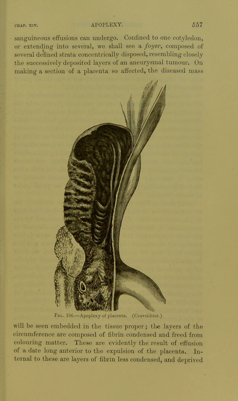 sanguineoxas eflfusions can undergo. Confined to one cotyledon, or extending into several, we shall see a foyer, composed of several defined strata concentrically disposed, resembling closely the successively dejjosited layers of an aneui-ysmal tumour. On making a section of a placenta so affected, the diseased mass Fio. lOG.—Apoplexy of placenta. (Ciiiveilhier.) will be seen embedded in the tissue proper; the layers of the circumference are composed of fibrin condensed and freed from colouring matter. These are evidently the result of efi'usion of a date long anterior to the expulsion of the placenta. In- ternal to these are layers of fibrin less condensed, and deprived