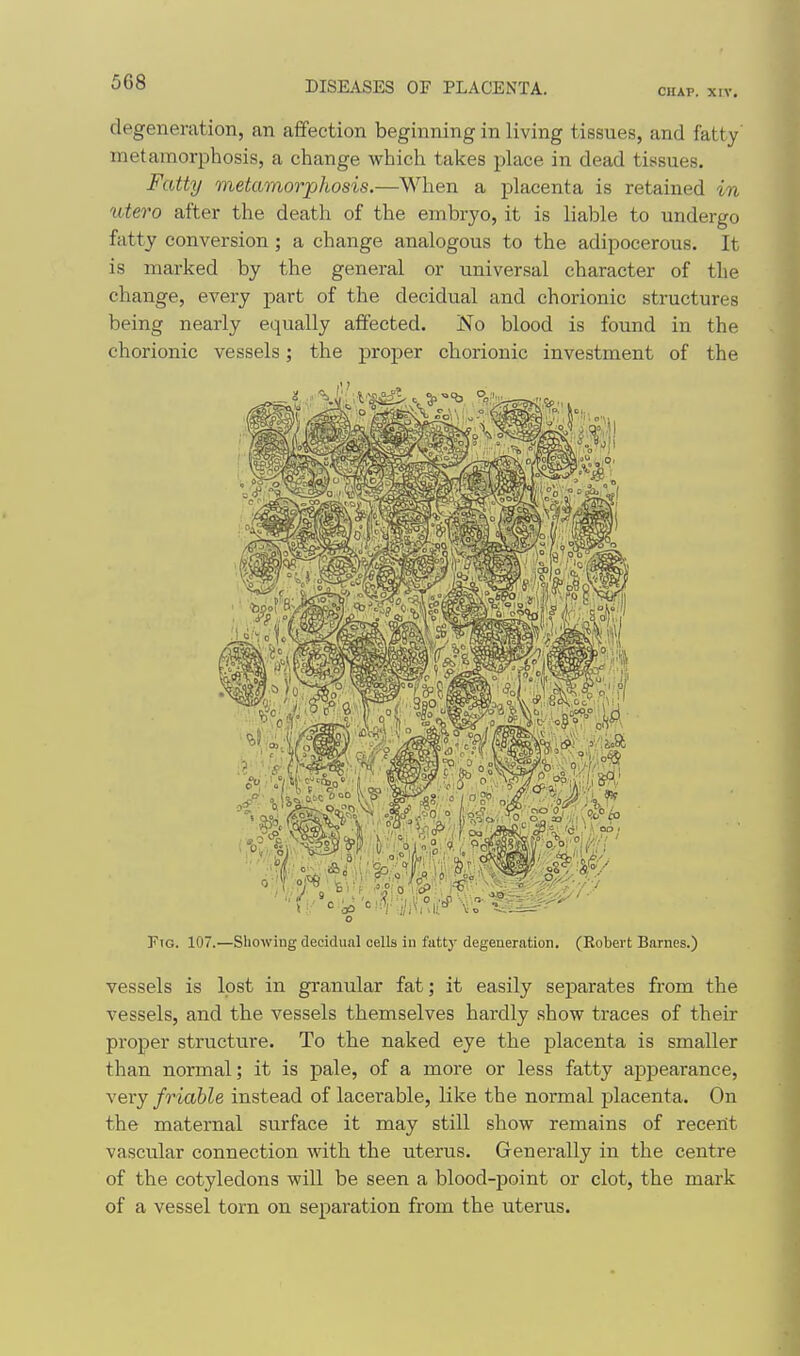 degeneration, an affection beginning in living tissues, and fatty' metamorphosis, a change which takes place in dead tissues. Fatty metamorphosis.—When a placenta is retained in Xitero after the death of the embryo, it is liable to undergo fatty conversion ; a change analogous to the adipocerous. It is marked by the general or universal character of the change, every part of the decidual and chorionic structures being nearly equally affected. No blood is found in the chorionic vessels; the proper chorionic investment of the Fio. 107.—Showing decidual cells in fattj' degeneration. (Robert Barnes.) vessels is lost in granular fat; it easily separates from the vessels, and the vessels themselves hardly .show traces of their proper structure. To the naked eye the placenta is smaller than normal; it is pale, of a more or less fatty appearance, xery friable instead of lacerable, like the normal placenta. On the maternal surface it may still show remains of recent vascular connection with the uterus. Generally in the centre of the cotyledons will be seen a blood-point or clot, the mark of a vessel torn on separation from the uterus.