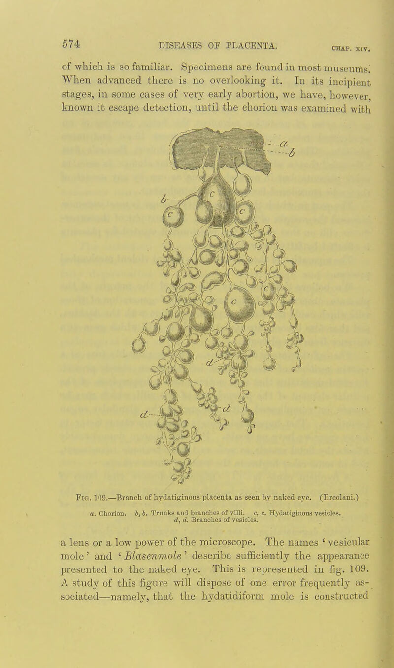 CIIAP. XIV. of which is so familiar. Specimens are found in most museurhsi When advanced there is no overlooking it. In its incipient stages, in some cases of very early abortion, we have, however, known it escape detection, until the chorion was examined with Fig. 109.—Branch of hydatiginous placenta as seen by naked eye. (Ercolani.) a. Chorion, b, b. Truuks and branches of villi, c, c. Hydatigiuous vesicles. d, d. Branches of vesicles. a lens or a low power of the microscope. The names ' vesicular mole' and ' BLasenmole' describe sufficiently the appearance presented to the naked eye. This is represented in fig. 109. A study of this figure will dispose of one error frequently as- sociated—namely, that the hydatidiform mole is constructed