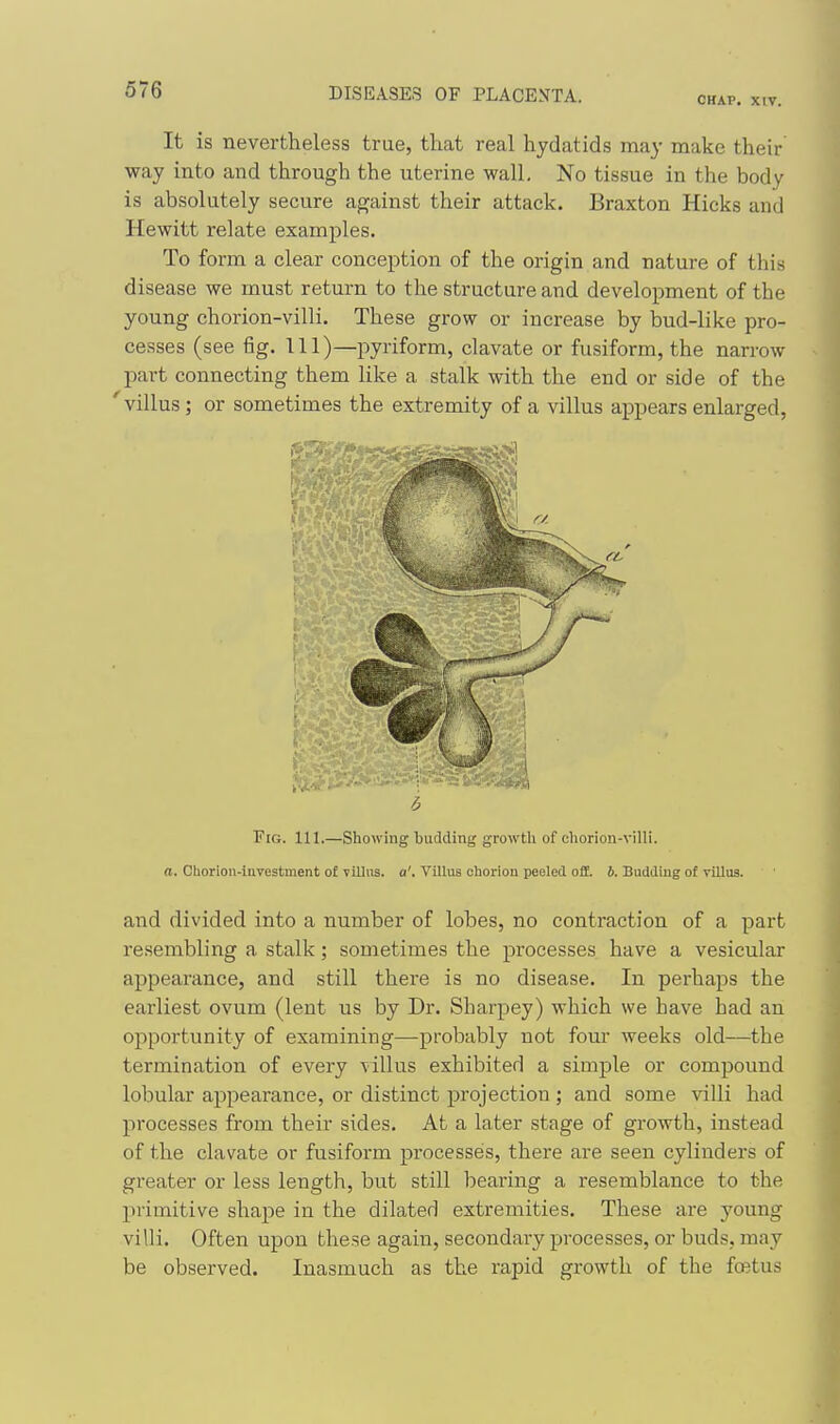 CHAP. XIV. It is nevertheless true, that real hydatids may make their way into and through the uterine wall. No tissue in the body is absolutely secure against their attack. Braxton Hicks and Hewitt relate examples. To form a clear conception of the origin and nature of this disease we must return to the structure and development of the young chorion-villi. These grow or increase by bud-like pro- cesses (see fig. Ill)—pyriform, clavate or fusiform, the narrow part connecting them like a stalk with the end or side of the 'villus ; or sometimes the extremity of a villus appears enlarged, b Fig. 111.—Showing budding growtli of chorion-villi. (I. Cliorioii-luvestment o£ villus, a'. Villus chorion peeled off. h. Buililiug at villus. and divided into a number of lobes, no contraction of a part resembling a stalk; sometimes the processes have a vesicular appearance, and still there is no disease. In perhaps the earliest ovum (lent us by Dr. Sharpey) which we have had an opportunity of examining—probably not fom* weeks old—the termination of every villus exhibited a simple or compound lobular appearance, or distinct projection ; and some villi had processes from their sides. At a later stage of growth, instead of the clavate or fusiform processes, there are seen cylinders of greater or less length, but still bearing a resemblance to the jirimitive shape in the dilated extremities. These are young villi. Often upon these again, secondary processes, or buds, may be observed. Inasmuch as the rapid growth of the foetus