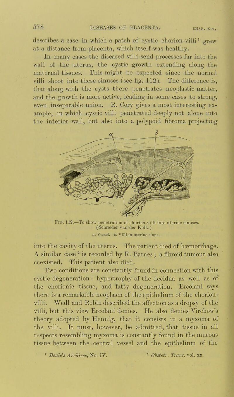 6-78 CHAP. XIV. describes a case in which a patch of cystic cliorion-villi' grew at a distance from placenta, which itself was healthy. In many cases the diseased villi send processes far into the wall of the uterus, the cystic growth extending along the maternal tissues. This might be expected since the normal villi shoot into these sinuses {see fig. 112). The difference is, that along with the cysts there penetrates neoplastic matter, and the growth is more active, leading in some cases to strong, even inseparable union. R. Cory gives a most interesting ex- ample, in which cystic villi penetrated deeply not alone into the interior wall, but also into a polypoid fibroma projecting Fio. 112.—To show penetration of chorion-villi into uterine sinuses. (Schroeder van der Kolk.) a. Vessel, b. ViUi iu uterine sinus. into the cavity of the uterus. The patient died of haemorrhage. A similar case ^ is recorded by E. Barnes ; a fibroid tumour also coexisted. This patient also died. Two conditions ai'e constantly found in connection with this cystic degeneration : hypertrophy of the decidua as well as of the chorionic tissue, and fatty degeneration. Ercolani says there is a remarkable neoplasm of the epithelium of the chorion- villi. Wedl and Eobin described the affection as a dropsy of the villi, but this view Ercolani denies. He also denies Virchow's theory adopted by Hennig, that it consists in a myxoma of the villi. It must, however, be admitted, that tissue in all respects resembling myxoma is constantly found in the mucous tissue between the central vessel and the epithelium of the ■ Beale'a Archives, No. IV. ^ Ohstetr. Trans, vol. xx.