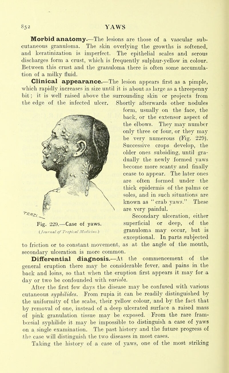 85 2 YAWS Morbid anatomy.—The lesions are those of a vascular sub- cutaneous granuioma. The skin overlying the growths is softened, and keratinization is imperfect. The epithelial scales and serous discharges form a crust, which is frequently sulphur-yellow in colour. Between this crust and the granuloma there is often some accumula- tion of a milky fluid. Clinical appearance.—The lesion appears first as a pimple, ■which rapidly increases in size until it is about as large as a threepenny bit; it is well raised above the surrounding skin or projects from the edge of the infected ulcer. Shortly afterwards other nodules form, usually on the face, the back, or the extensor aspect of the elbows. They may number only three or four, or they may be very numerous (Fig. 229). Successive crops develop, the older ones subsiding, until gra- dually the newly formed yaws become more scanty and finally cease to appear. The later ones are often formed under the thick epidermis of the palms or soles, and in such situations are known as crab yaws. These are very painful. Secondary ulceration, either Fig. 229.—Case of yaws. superficial or deep, of the (jo,„-nai nf Tropical Mcdkine.) granuloma may occur, but is exceptional. In parts subjected to friction or to constant movement, as at the angle of the mouth, secondary ulceration is more common. Differential diagnosis.—At the commencement of the general eruption there may be considerable fever, and pains in the back and loins, so that when the eruption first appears it may for a day or two be confounded with variola. After the first few days the disease may be confused with various cutaneous s^jfliilides. From rupia it can be readily distinguished by the uniformity of the scabs, their yellow colour, and by the fact that by removal of one, instead of a deep ulcerated surface a raised mass of pink granulation tissue may be exposed. From the rare fram- boesial syphilide it may be impossible to distinguish a case of yaws on a single examination. The past history and the future progress of the case will distinguish the two diseases in most cases. Taking the history of a case of yaws, one of the most striking