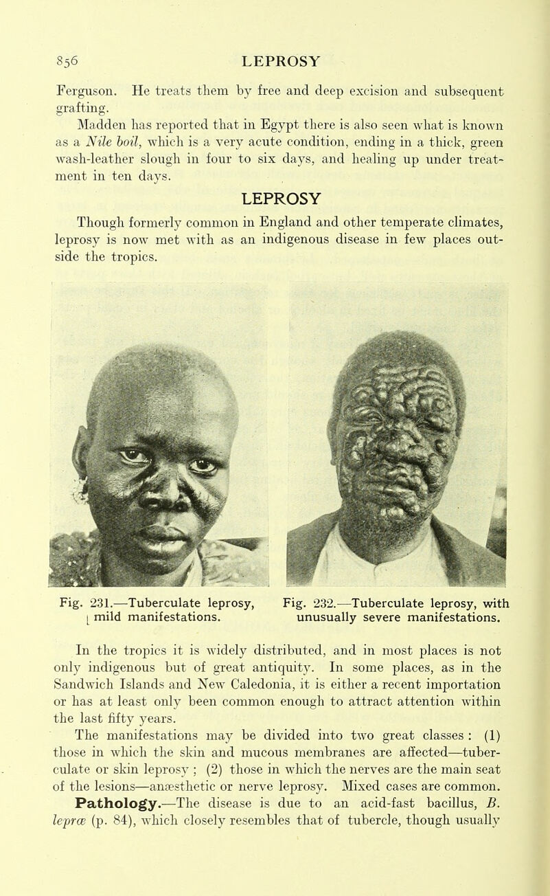 Ferguson. He treats them by free and deep excision and subsequent grafting. Madden lias reported that in Egypt there is also seen what is loiown as a Nile boil, which is a very acute condition, ending in a thick, green wash-leather slough in four to six days, and healing up under treat- ment in ten days. LEPROSY Though formerly common in England and other temperate climates, leprosy is now met with as an indigenous disease in few places out- side the tropics. Fig. 231.—Tuberculate leprosy, Fig. 232.—Tuberculate leprosy, with [ mild manifestations. unusually severe manifestations. In the tropics it is widely distributed, and in most places is not only indigenous but of gxeat antiquity. In some places, as in the Sandwich Islands and New Caledonia, it is either a recent importation or has at least only been common enough to attract attention within the last fifty years. The manifestations may be divided into two great classes : (1) those in which the skin and mucous membranes are affected—tuber- culate or skin leprosy ; (2) those in which the nerves are the main seat of the lesions—anaesthetic or nerve leprosy. Mixed cases are common. Pathology.—The disease is due to an acid-fast bacillus, B. leprcB (p. 84), which closely resembles that of tubercle, though usually