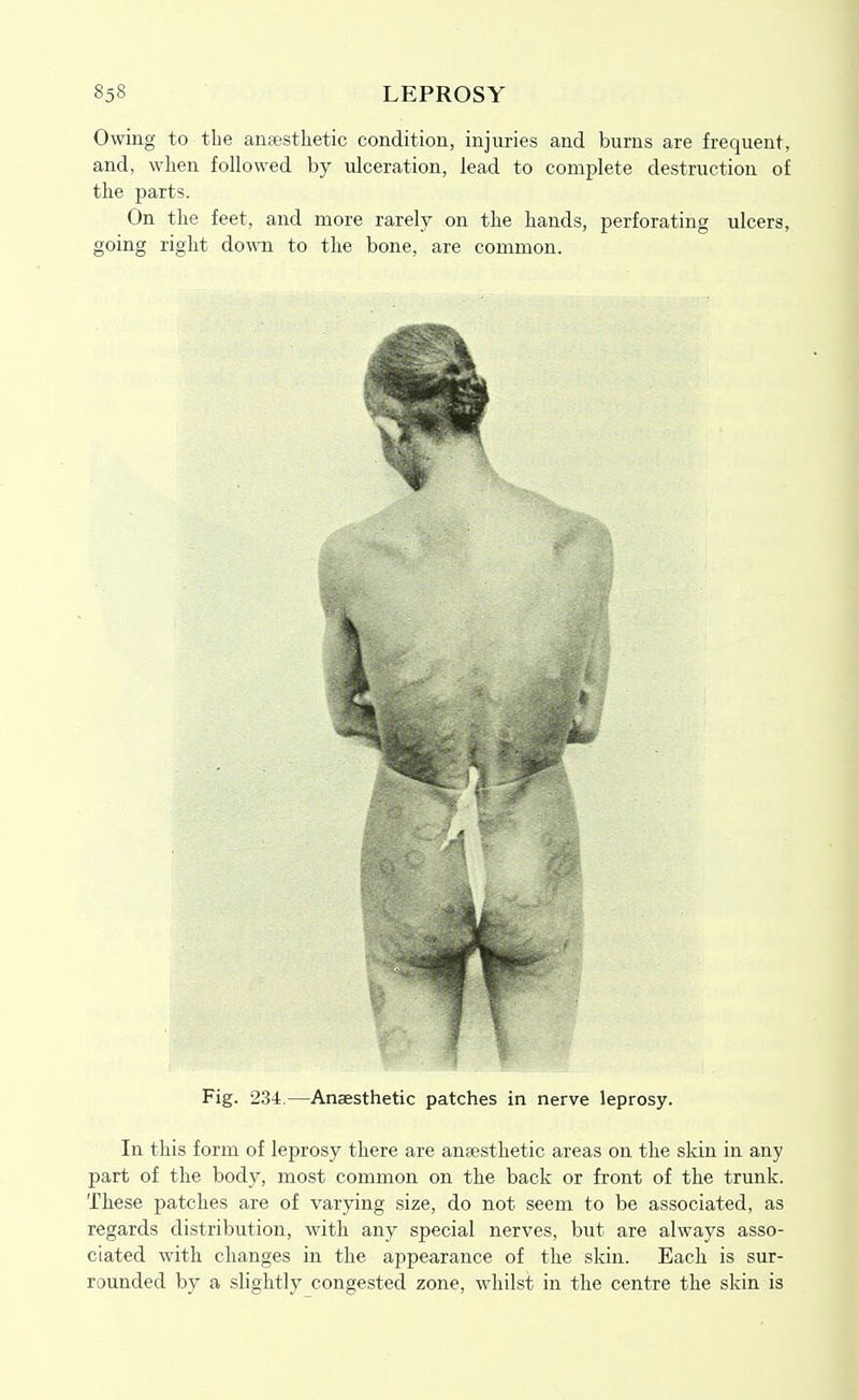 Owing to the anesthetic condition, injuries and bums are frequent, and, when followed by ulceration, lead to complete destruction of the parts. On the feet, and more rarely on the hands, perforating ulcers, going right down to the bone, are common. Fig. 23-t,—Anaesthetic patches in nerve leprosy. In this form of leprosy there are anaesthetic areas on the skin in any part of the body, most common on the back or front of the trunk. These patches are of varying size, do not seem to be associated, as regards distribution, with any special nerves, but are always asso- ciated with changes in the appearance of the skin. Each is sur- rounded by a slightly congested zone, whilst in the centre the skin is