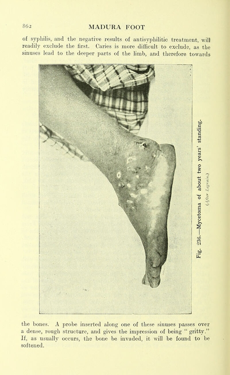 of syphilis, and the negative results of antisyphilitic treatment, will readily exclude the first. Caries is more difficult to exclude, as the sinuses lead to the deeper parts of the limb, and therefore towards the bones. A probe inserted along one of these sinuses passes over a dense, rough structure, and gives the impression of being  gritty. If, as usually occurs, the bone be invaded, it will be found to be softened.