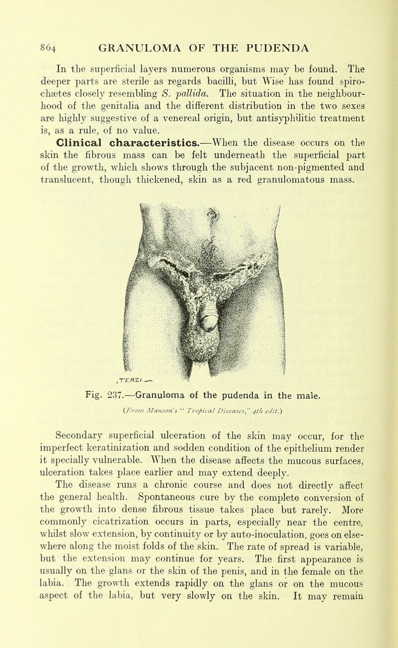 In the superficial layers numerous organisms may be found. The deeper parts are sterile as regards bacilli, but Wise has found spiro- chsetes closely resembling *S. follida. The situation in the neighbour- hood of the genitalia and the different distribution in the two sexes are highly suggestive of a venereal origin, but antisyphilitic treatment is, as a rule, of no value. Clinical characteristics.—When the disease occurs on the skin the fibrous mass can be felt underneath the superficial part of the growth, which shows through the subjacent non-pigmented and translucent, though thickened, skin as a red granulomatous mass. Fig. 237.—Granuloma of the pudenda in the male. (Frtvii Malison's  Tiopical Diseases, 4tli edit.) Secondary superficial ulceration of the skin may occur, for the imperfect keratinization and sodden condition of the epithelium render it specially vulnerable. When the disease affects the mucous surfaces, ulceration takes place earlier and may extend deeply. The disease runs a chronic course and does not directly affect the general health. Spontaneous cure by the complete conversion of the growth into dense fibrous tissue takes place but rarely. More commonly cicatrization occurs in parts, especially near the centre, whilst slow extension, by continuity or by auto-inoculation, goes on else- where along the moist folds of the skin. The rate of spread is variable, but the extension may continue for years. The first appearance is usually on the glans or the sldn of the penis, and in the female on the labia. The growth extends rapidly on the glans or on the mucous aspect of the labia, but very slowly on the sldn. It may remain