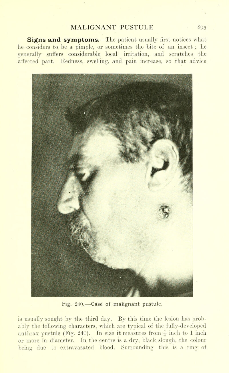 Signs and symptoms.—The patient usually first notices what he considers to be a pimple, or sometimes the bite of an insect; he generally suffers considerable local irritation, and scratches the afiected part. Redness, swelling, and pain increase, so that advice Fig. 240.—Case of malignant pustule. is usually sought by the third day. By this time the lesion has prob- ably the following characters, which are typical of the fully-developed anthrax pustule (Fig. 24(»). In size it measures from J inch to 1 inch or more in diameter. In the centre is a dry, black slough, the colour being due to extravasated blood. Surrounding this is a ring of