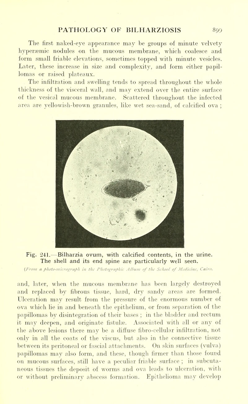 The first naked-eye appearance may be groups of minute velvety liypersemic nodules on tlie mucous membrane, wliicli coalesce and form small friable elevations, sometimes topped with minute vesicles. Later, these increase in size and complexity, and form either papil- lomas or raised plateaux. The infiltration and swelling tends to spread throughout the whole thickness of the visceral wall, and may extend over the entire surface of the vesical mucous membrane. Scattered throughout the infected area are yellowish-brown granules, like wet sea-sand, of calcified ova ; Fig. 241.—Bilharzia ovum, with calcified contents, in the urine. The shell and its end spine are particularly well seen. (From a photo-miL tvgyaph in the I'hot.-'gya/thic Album of tho School of Mclicino, Cairo. and, later, when the mucous membrane has been largely destroyed and replaced by fibrous tissue, hard, dry sandy areas are formed. Ulceration may result from the pressure of the enormous number of ova wliich lie in and beneath the epithelium, or from separation of the papillomas by disintegration of their bases ; in the bladder and rectum it may deepen, and originate fistulse. Associated with all or any of the above lesions there may be a difiuse fibro-cellular infiltration, not only in all the coats of the viscus, but also in the connective tissue between its peritoneal or fascial attachments. On skin surfaces (vulva) papillomas may also form, and these, though firmer than those found on mucous surfaces, still have a peculiar friable surface ; in subcuta- neous tissues the deposit of worms and ova leads to ulceration, with or without preliminary abscess formation. Epithelioma may develop