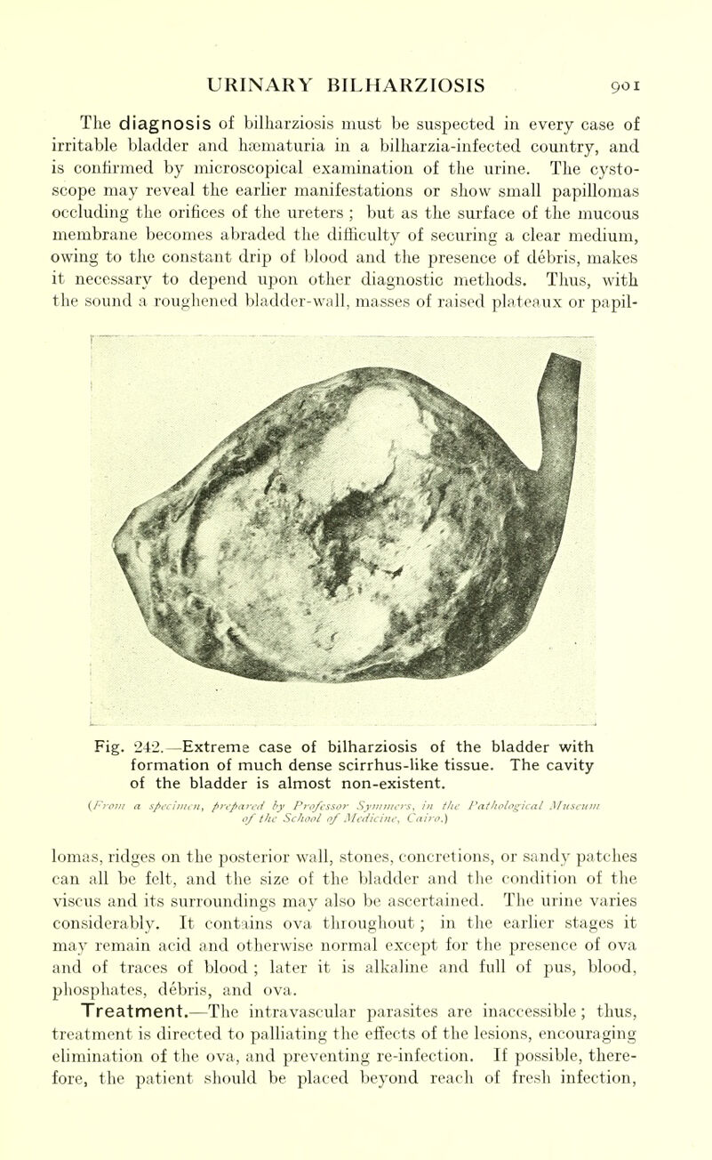 The diagnosis of billiarziosis must be suspected in every case of irritable bladder and haematuria in a bilharzia-infected country, and is confirmed by microscopical examination of the urine. The cysto- scope may reveal the earlier manifestations or show small papillomas occluding the orifices of the ureters ; but as the surface of the mucous membrane becomes abraded the difficulty of securing a clear medium, owing to the constant drip of blood and the presence of debris, makes it necessary to depend upon other diagnostic methods. Thus, with the sound a roughened bladder-wall, masses of raised plateaux or papil- Fig. 242.—Extreme case of bilharziosis of the bladder with formation of much dense scirrhus-like tissue. The cavity of the bladder is almost non-existent. i^FroTil a s/>t\ iiNt n, prt'pai'Cii hv Pro/t'ssoy Syuniit-is, In the J'af/inlo'^-ital Musi uln of the School of Mt 'diciiu-, Cairo.) lomas, ridges on the posterior wall, stones, concretions, or sandy patches can all be felt, and the size of the bladder and tlie condition of the viscus and its surroundings may also be ascertained. The urine varies considerably. It contains ova throughout; in the earlier stages it may remain acid and otherwise normal except for the presence of ova and of traces of blood ; later it is alkaline and full of pus, blood, phosphates, debris, and ova. Treatment.—The intravascular parasites are inaccessible ; thus, treatment is directed to palliating the effects of the lesions, encouraging elimination of the ova, and preventing re-infection. If possible, there- fore, the patient should be placed beyond reach of fresh infection, r—