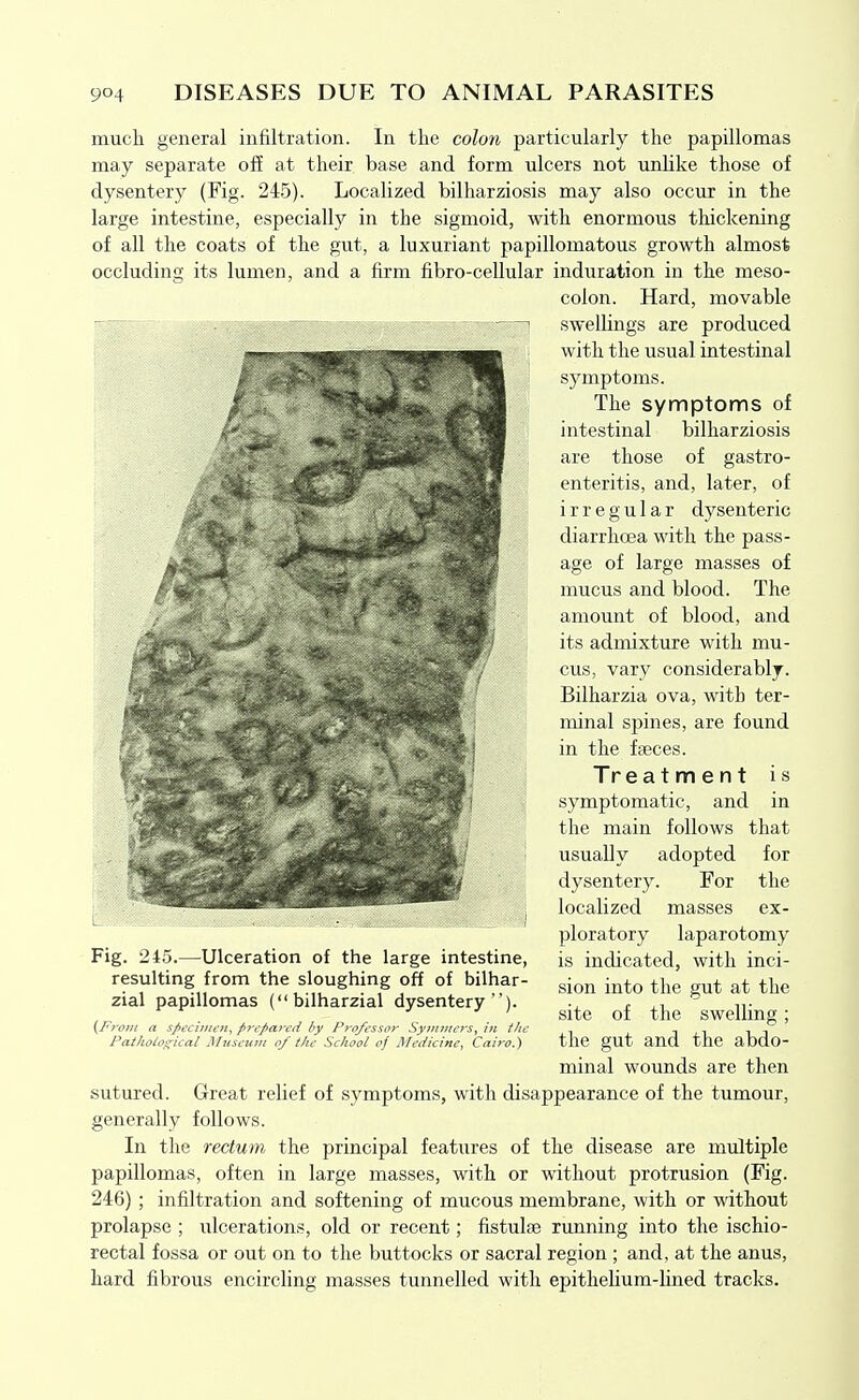 much general infiltration. In the colon particularly the papillomas may separate off at their base and form ulcers not unlike those of dysentery (Fig. 245). Localized bilharziosis may also occur in the large intestine, especially in the sigmoid, with enormous thickening of all the coats of the gut, a luxuriant papillomatous growth almost occluding its lumen, and a firm fibro-cellular induration in the meso- colon. Hard, movable swellings are produced with the usual intestinal symptoms. The symptoms of intestinal bilharziosis are those of gastro- enteritis, and, later, of irregular dysenteric diarrhoea with the pass- age of large masses of mucus and blood. The amount of blood, and its admixture with mu- cus, vary considerably. Bilharzia ova, with ter- minal spines, are found in the faeces. Treatment is symptomatic, and in the main follows that usually adopted for dysentery. For the localized masses ex- ploratory laparotomy is indicated, with inci- sion into the gut at the site of the swelling; the gut and the abdo- minal wounds are then sutured. Great relief of symptoms, with disappearance of the tumour, generally follows. In the rectum the principal features of the disease are multiple papillomas, often in large masses, with or without protrusion (Fig. 246) ; infiltration and softening of mucous membrane, with or without prolapse ; ulcerations, old or recent; fistulse ruxming into the ischio- rectal fossa or out on to the buttocks or sacral region ; and, at the anus, hard fibrous encircling masses tunnelled with epithelium-lined tracks. Fig. 245.—Ulceration of the large intestine, resulting from the sloughing off of bilhar- zial papillomas (bilharzial dysentery). {_Froj7t a sj>ecijnen, prepared by Professor Syimners, in the Pathological Museunt of the School of Medicine^ Cairo,')
