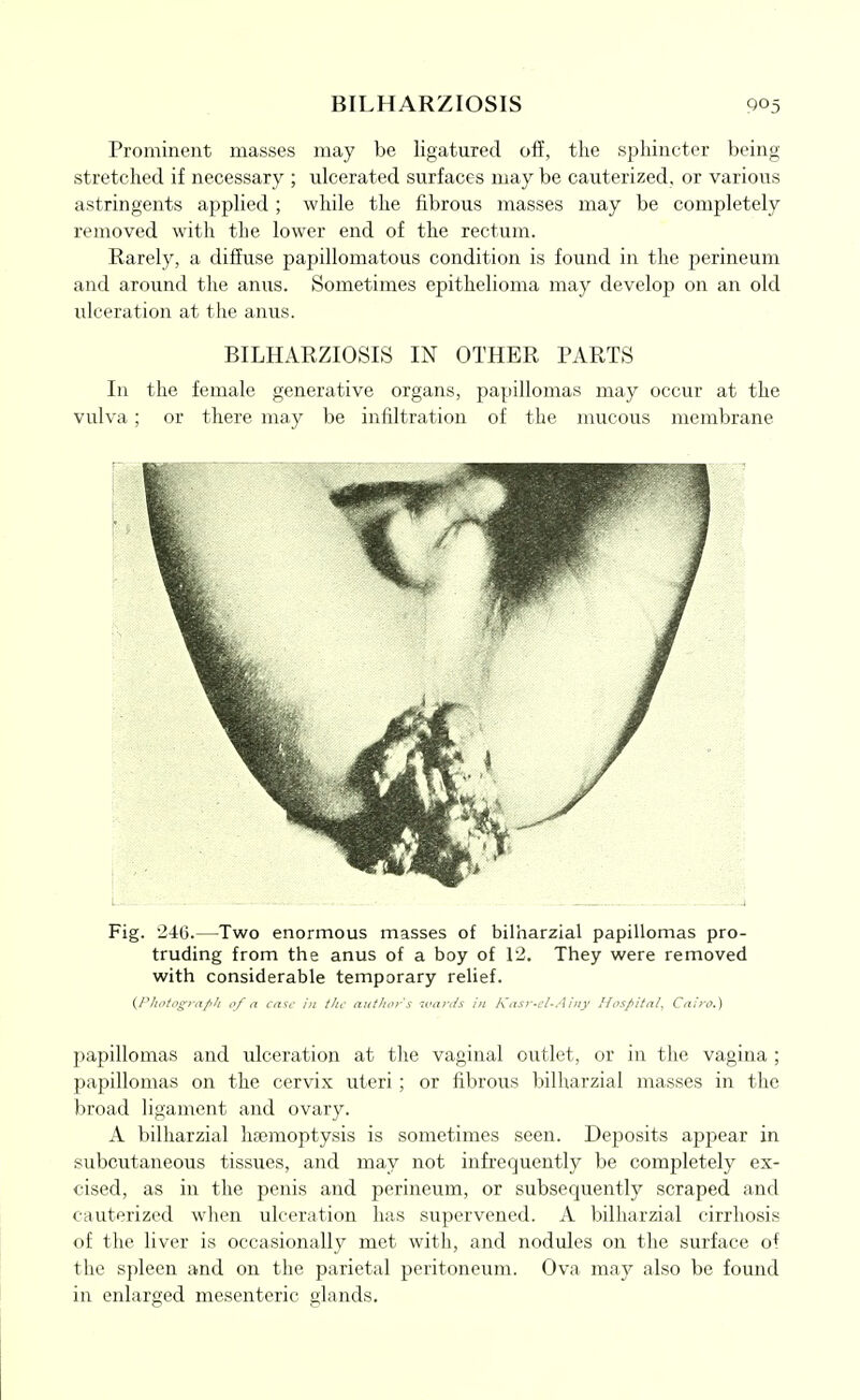 Prominent masses may be ligatured off, the sphincter being- stretched if necessary ; nlcerated surfaces may be cauterized, or various astringents applied ; while the fibrous masses may be completely removed with the lower end of the rectum. Rarely, a diffuse papillomatous condition is found in the perineum and around the anus. Sometimes epithelioma may develop on an old ulceration at the anus. BILHARZIOSIS IN OTHER PARTS In the female generative organs, papillomas may occur at the vulva ; or there may be infiltration of the mucous membrane Fig. 246.—Two enormous masses of bilharzial papillomas pro- truding from the anus of a boy of 12. They were removed with considerable temporary relief. (Pliotogra/'/i ,1/ a (-,ivt' /// tJic autlior's iva>;/.s in Kasr-cl-Aiiiy Hospital, Cairo.) papillomas and ulceration at the vaginal outlet, or in the vagina ; papillomas on the cervix uteri; or fibrous bilharzial masses in the broad ligament and ovary. A bilharzial haemoptysis is sometimes seen. Deposits appear in subcutaneous tissues, and may not infrequently be completely ex- cised, as in the penis and perineum, or subsequently scraped and cauterized when ulceration has supervened. A bilharzial cirrhosis of the liver is occasionally met with, and nodules on the surface of the spleen and on the parietal peritoneum. Ova may also be found in enlarged mesenteric glands.