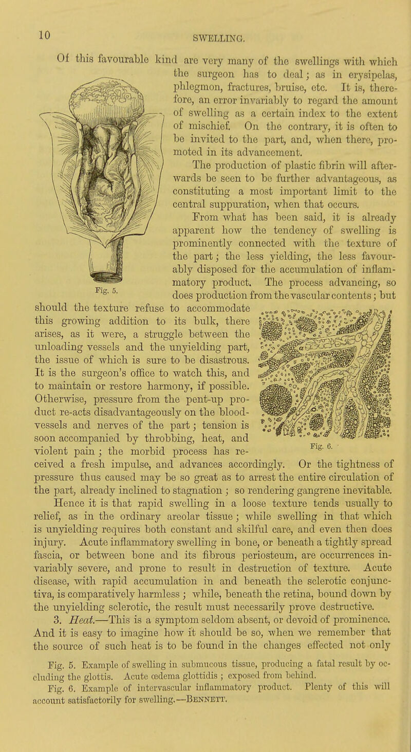 SWELLING. Kg. 5. Of this favourablG kind are very many of tho swellings with which the surgeon has to deal; as in erysipelas, phlegmon, fractures, bruise, etc. It is, there- fore, an error invariably to regard the amount of swelling as a certain index to the extent of mischief. On the contrary, it is often to be invited to the part, and, when there, pro- moted in its advancement. The production of plastic fibrin will after- wards be seen to be further advantageous, as constituting a most important limit to the central suppuration, when that occurs. From what has been said, it is already apparent how the tendency of swelling is prominently connected with the texture of the part; the less yielding, the less favour- ably disposed for the accumulation of inflam- matory product. The process advancing, so does production from the vascular contents; but should the texture refuse to accommodate this growing addition to its bulk, there arises, as it were, a struggle between the unloading vessels and the unyielding part, the issue of which is sure to be disastrous. It is the surgeon's office to watch this, and to maintain or restore harmony, if possible. Otherwise, pressure from the pent-up pro- duct re-acts disadvantageously on the blood- vessels and nerves of the part; tension is soon accompanied by throbbing, heat, and violent pain ; the morbid process has re- ceived a fresh impulse, and advances accordingly. Or the tightness of pressure thus caused may be so great as to arrest the entire circnlation of the part, already inclined to stagnation ; so rendering gangrene inevitable. Hence it is that rapid swelling in a loose texture tends usually to relief, as in the ordinary areolar tissue; while swelling in that Avhich is unyielding requires both constant and skilful care, and even then does injury. Acute inflammatory swelling in bone, or beneath a tightly spread fascia, or between bone and its fibrous periosteum, are occurrences in- variably severe, and prone to result in destruction of texture. Acute disease, with rapid accumulation in and beneath the sclerotic conjunc- tiva, is comparatively harmless ; wliile, beneath the retina, bound down by the unyielding sclerotic, the result must necessarily prove destructive. 3. Heat.—This is a symptom seldom absent, or devoid of prominence. And it is easy to imagine ho a? it should be so, when we remember that the source of such heat is to be found in the changes effected not only Fig. 5. Example of swelling in submucous tissue, producing a fatal result by oc- cluding tlie glottis. Acute oedema glottidis ; exposed from behind. Fig. 6. Example of intcrvascular inflammatory j)roduct. Plenty of this Avill account satisfactorily for swelling.—Bennett. Fig. 6.