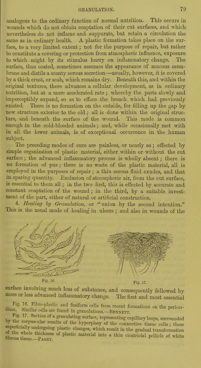 analogous to the ordinary function of normal nutrition. This occurs in wounds wliich do not obtain coaptation of their cut surfaces, and which nevertheless do not inflame and suppurate, but retain a circulation the same as in ordinary health. A plastic formation takes place on the sur- face, to a very limited extent; not for the piu'pose of repair, but rather to constitute a covering or protection from atmospheric influence, exposure to which might by its stimulus hurry on inflammatory change. The surface, thus coated, sometimes assumes the appearance of mucous mem- brane and distils a scanty serous secretion—usually, however, it is covered by a thick crust, or scab, wliich remains dry. Beneath this, and within the original textures, there advances a cellular development, as in ordinary nutrition, but at a more accelerated rate ; whereby the parts slowly and imperceptibly expand, so as to eff'ace the breach which had previously existed. There is no formation on the outside, for filling up the gap by new structure exterior to the old; all is done within the original struc- ture, and beneath the surface of the wound. This mode is common enough in the cold-blooded animals; and, while occasionally met with in all the lower animals, is of exceptional occurrence in the human subject. The preceding modes of cure are painless, or nearly so; efiected by simple organization of plastic material, either within or without the cut surface; the advanced inflammatory process is wholly absent; there is no formation of pus ; there is no waste of the plastic material, all is employed in the purposes of repair; a thin serous fluid exudes, and that in sparing quantity. Exclusion of atmospheric air, from the cut surface, is essential to them aU; in the two first, this is effected by accurate and constant coaptation of the wound; in the third, by a suitable invest- ment of the part, either of natural or artificial construction. 4. Healing hy Granulation, or union by the second intention. This is the usual mode of healing* in ulcers ; and also in wounds of the Fig. 16. j,.g_ surface involving much loss of substance, and consequently followed by more or less advanced inflammatory change. The first and most essential Fig. 16. Fibro-pla.stic and fnsiform cells from recent formations on the pericar- aium. Similar cells are found in granulations.—Bennett. Fig. 17. Section of a granulating surface, representing capillary loops, surrounded by the corpuscular results of the hyperplasy of the connective tissue cells ; these superficially undergoing plastic changes, which result in the gradual transformation 0 the whole thickness of plastic material into a thin cicatricial pellicle of white nbrous tissue.—Paget.