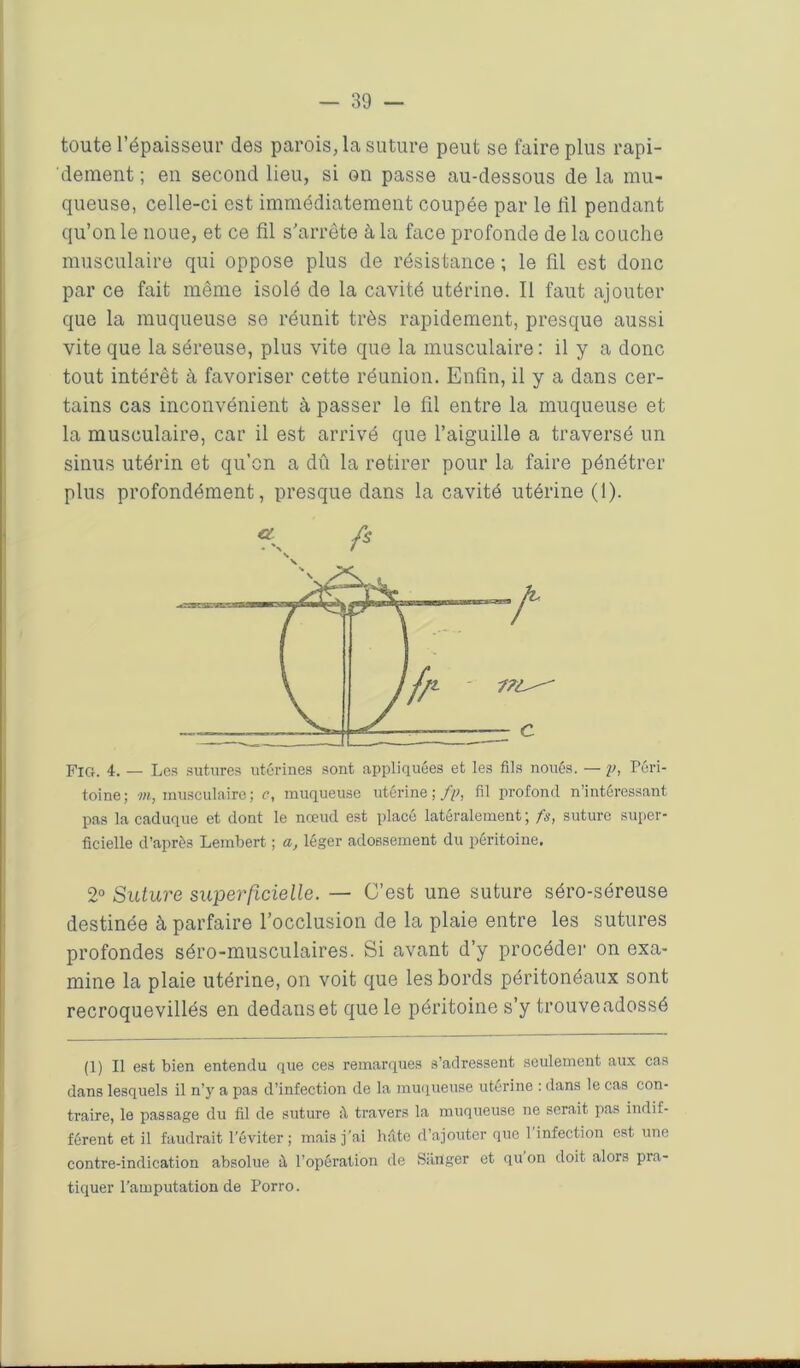 toute l’épaisseur des parois, la suture peut se faire plus rapi- dement ; en second lieu, si on passe au-dessous de la mu- queuse, celle-ci est immédiatement coupée par le fil pendant qu’on le noue, et ce fil s’arrête à la face profonde de la couche musculaire qui oppose plus de résistance ; le fil est donc par ce fait même isolé de la cavité utérine. Il faut ajouter que la muqueuse se réunit très rapidement, presque aussi vite que la séreuse, plus vite que la musculaire : il y a donc tout intérêt à favoriser cette réunion. Enfin, il y a dans cer- tains cas inconvénient à passer le fil entre la muqueuse et la musculaire, car il est arrivé que l’aiguille a traversé un sinus utérin et qu’on a dû la retirer pour la faire pénétrer plus profondément, presque dans la cavité utérine (1). Fig. 4. _ Les sutures utérines sont appliquées et les fils noués. — p, Péri- toine; m, musculaire ; c, muqueuse utérine ; fp, fil profond n’intéressant pas la caduque et dont le nœud est placé latéralement; fs, suture super- ficielle d’après Lembert ; a, léger adossement du péritoine. 2° Suture superficielle. — C’est une suture séro-séreuse destinée à parfaire l’occlusion de la plaie entre les sutures profondes séro-musculaires. Si avant d’y procéder on exa- mine la plaie utérine, on voit que les bords péritonéaux sont recroquevillés en dedans et que le péritoine s’y trouveadossé (1) Il est bien entendu que ces remarques s’adressent seulement aux cas dans lesquels il n’y a pas d’infection de la muqueuse utérine : dans le cas con- traire, le passage du fil de suture travers la muqueuse ne serait pas indif- férent et il faudrait l’éviter; mais j’ai hâte d’ajouter que 1 infection est une contre-indication absolue ù, l’opération de Sànger et qu on doit alors pra- tiquer l’amputation de Porro.