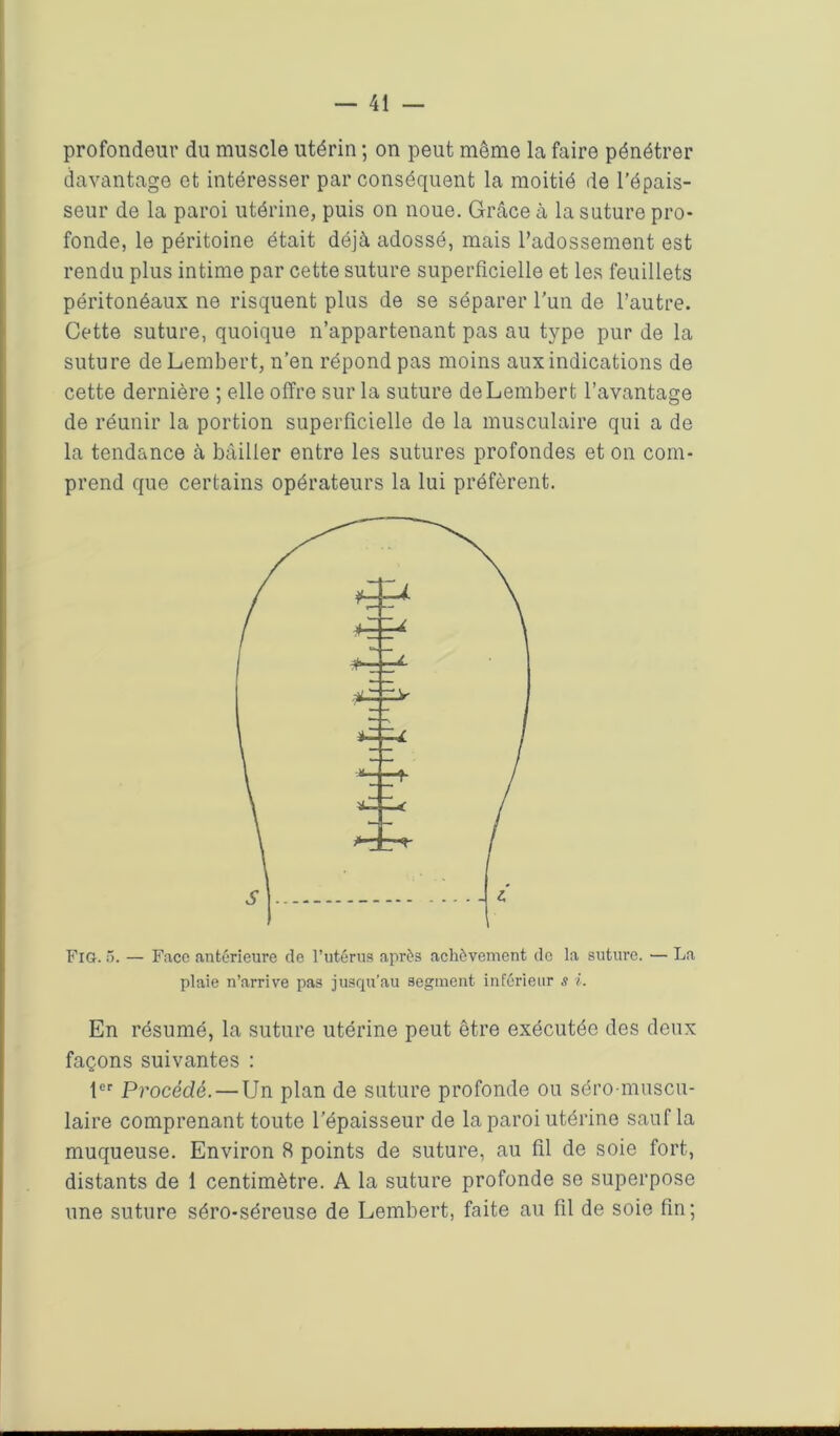 profondeur du muscle utérin ; on peut même la faire pénétrer davantage et intéresser par conséquent la moitié de l’épais- seur de la paroi utérine, puis on noue. Grâce à la suture pro- fonde, le péritoine était déjà adossé, mais l’adossement est rendu plus intime par cette suture superficielle et les feuillets péritonéaux ne risquent plus de se séparer l’un de l’autre. Cette suture, quoique n’appartenant pas au type pur de la suture deLembert, n’en répond pas moins aux indications de cette dernière ; elle offre sur la suture deLembert l’avantage de réunir la portion superficielle de la musculaire qui a de la tendance à bâiller entre les sutures profondes et on com- prend que certains opérateurs la lui préfèrent. Fig. 5. — Face antérieure de l’utérus après achèvement de la suture. — La plaie n’arrive pas jusqu’au segment inférieur s ?.. En résumé, la suture utérine peut être exécutée des deux façons suivantes : 1er Procédé. — Un plan de suture profonde ou séro muscu- laire comprenant toute l’épaisseur de la paroi utérine sauf la muqueuse. Environ 8 points de suture, au fil de soie fort, distants de 1 centimètre. A la suture profonde se superpose une suture séro-séreuse de Lembert, faite au fil de soie fin;