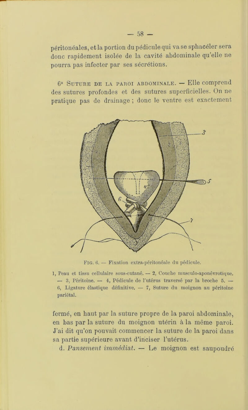 péritonéales, et la portion du pédicule qui va se sphacéler sera donc rapidement isolée de la cavité abdominale qu’elle ne pourra pas infecter par ses sécrétions. G0 Suture de la paroi ardominale. — Elle comprend des sutures profondes et des sutures superficielles. On ne pratique pas de drainage ; donc le ventre est exactement Fig. C>. — Fixation extra-péritonéale du pédicule. 1, Peau et tissu cellulaire sous-cutané.— 2, Couche musculo-aponévrotique. — B, Péritoine. — 4, Pédicule de l’utérus traversé par la broche 5. — 6, Ligature élastique définitive. — 7, Suture du moignon au péritoine pariétal. fermé, en haut par la suture propre de la paroi abdominale, en bas par la suture du moignon utérin à la môme paroi. J’ai dit qu’on pouvait commencer la suture de la paroi dans sa partie supérieure avant d’inciser l’utérus, d. Pansement immédiat. — Le moignon est saupoudré