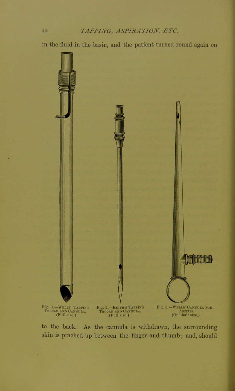 in the fluid in the basin, and the patient turned round again on Fig. 1.—Wells' Tapping Trocar and Cannula. (Full size.) Fig. 2.—Keith's Tapping Trocar and Cannula. (Full size.) Fig. 3.—Wells' Cannula for Ascites. (One-half size.) to the back. As the cannula is withdrawn, the surrounding skin is pinched up between the finger and thumb; and, should