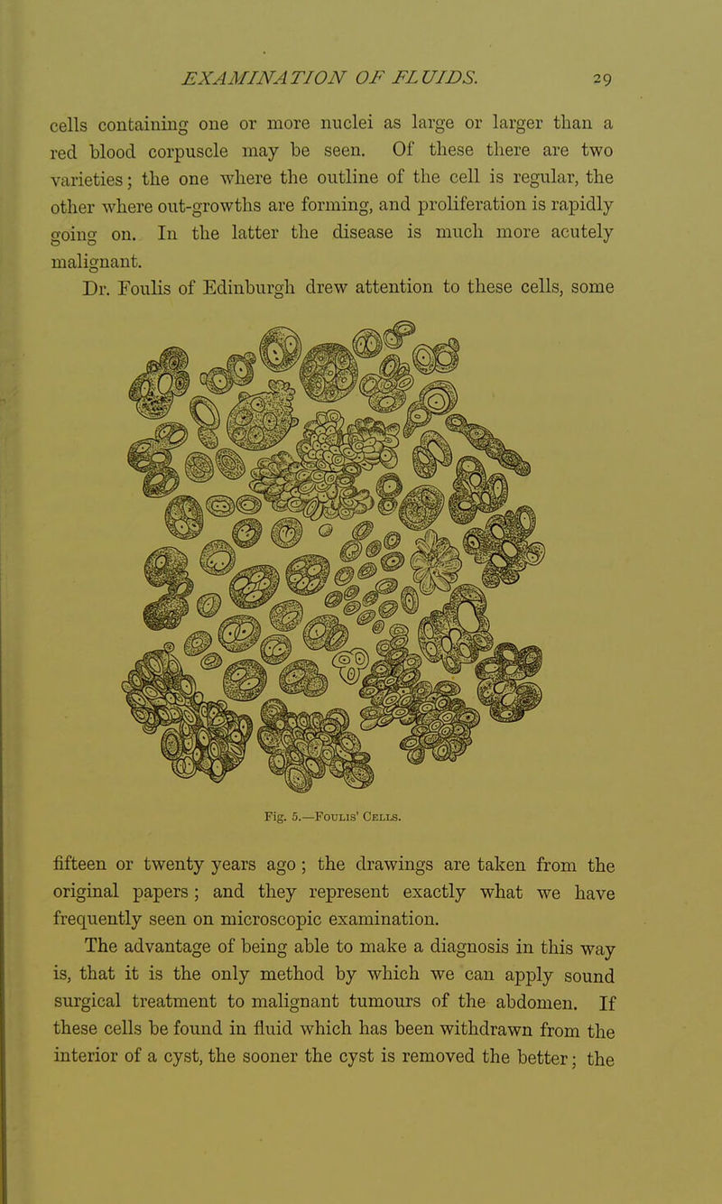 cells containing one or more nuclei as large or larger than a red blood corpuscle may be seen. Of these there are two varieties; the one where the outline of the cell is regular, the other where out-growths are forming, and proliferation is rapidly ooing on. In the latter the disease is much more acutely malignant. Dr. Foulis of Edinburgh drew attention to these cells, some Fig. 5.—Foulis' Cells. fifteen or twenty years ago ; the drawings are taken from the original papers; and they represent exactly what we have frequently seen on microscopic examination. The advantage of being able to make a diagnosis in this way is, that it is the only method by which we can apply sound surgical treatment to malignant tumours of the abdomen. If these cells be found in fluid which has been withdrawn from the interior of a cyst, the sooner the cyst is removed the better; the