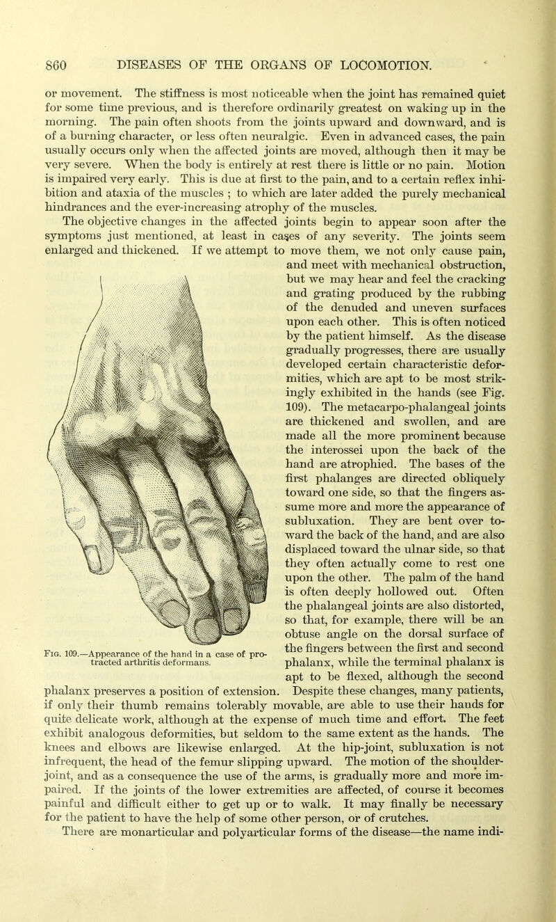 or movement. Tlie stiffness is most noticeable wlien the joint bas remained qniet for some time previous, and is therefore ordinarily greatest on waking up in the morning. The pain often shoots from the joints upward and downward, and is of a burning character, or less often neuralgic. Even in advanced cases, the pain usually occurs only when the affected joints are moved, although then it may be very severe. When the body is entirely at rest there is little or no pain. Motion is impaired very early. This is due at first to the pain, and to a certain reflex inhi- bition and ataxia of the muscles ; to which are later added the purely mechanical hindrances and the ever-increasing atrophy of the muscles. The objective changes in the affected joints begin to appear soon after the symptoms just mentioned, at least in cases of any severity. The joints seem enlarged and thickened. If we attempt to move them, we not only cause pain, and meet with mechanical obstruction, but we may hear and feel the cracking and grating produced by the rubbing of the denuded and uneven surfaces upon each other. This is often noticed by the patient himself. As the disease gradually progresses, there are usually developed certain characteristic defor- mities, which are apt to be most strik- ingly exhibited in the hands (see Fig. 109). The metacarpo-phalangeal joints are thickened and swollen, and are made all the more prominent because the interossei upon the back of the hand are atrophied. The bases of the first phalanges are directed obliquely toward one side, so that the fingers as- sume more and more the appearance of subluxation. They are bent over to- ward the back of the hand, and are also displaced toward the ulnar side, so that they often actually come to rest one upon the other. The palm of the hand is often deeply hollowed out. Often the phalangeal joints are also distorted, so that, for example, there will be an obtuse angle on the dorsal surface of the fingers between the first and second phalanx, while the terminal phalanx is apt to be flexed, although the second Despite these changes, many patients, if only their thumb remains tolerably movable, are able to use their hands for quite delicate work, although at the expense of much time and effort. The feet exhibit analogous deformities, but seldom to the same extent as the hands. The knees and elbows are likewise enlarged. At the hip-joint, subluxation is not infrequent, the head of the femur slipping upward. The motion of the shoulder- joint, and as a consequence the use of the arms, is gradually more and more im- paired. If the joints of the lower extremities are affected, of course it becomes painful and difficult either to get up or to walk. It may finally be necessary for the patient to have the help of some other person, or of crutches. There are monarticular and polyarticular forms of the disease—the name indi- phalanx preserves a position of extension.
