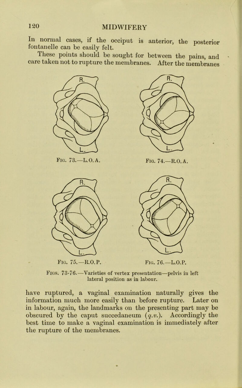 In normal cases, if the occiput is anterior, the posterior fontanelle can be easily felt. These points should be sought for between the pains, and care taken not to rupture the membranes. After the membranes Figs. 73-76.—Varieties of vertex presentation—pelvis in left lateral position as in labour. have ruptured, a vaginal examination naturally gives the information much more easily than before rupture. Later on in labour, again, the landmarks on the presenting part may be obscured by the caput succedaneum (q.v.). Accordingly the best time to make a vaginal examination is immediately after the rupture of the membranes.