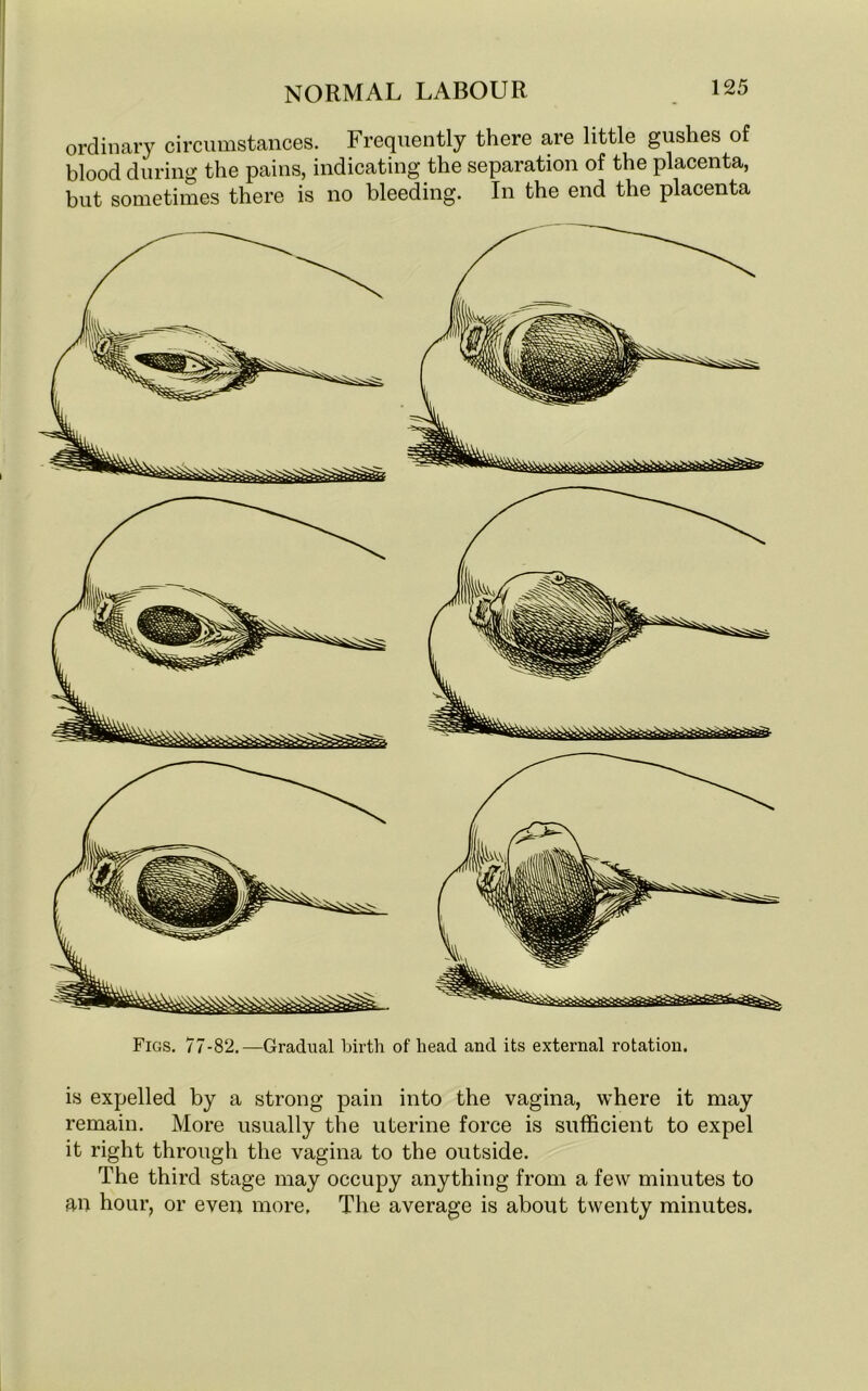 ordinary circumstances. Frequently there are little gushes of blood during the pains, indicating the separation of the placenta, but sometimes there is no bleeding. In the end the placenta Figs. 77-82.—Gradual birth of head and its external rotation. is expelled by a strong pain into the vagina, where it may remain. More usually the uterine force is sufficient to expel it right through the vagina to the outside. The third stage may occupy anything from a few minutes to an hour, or even more, The average is about twenty minutes.