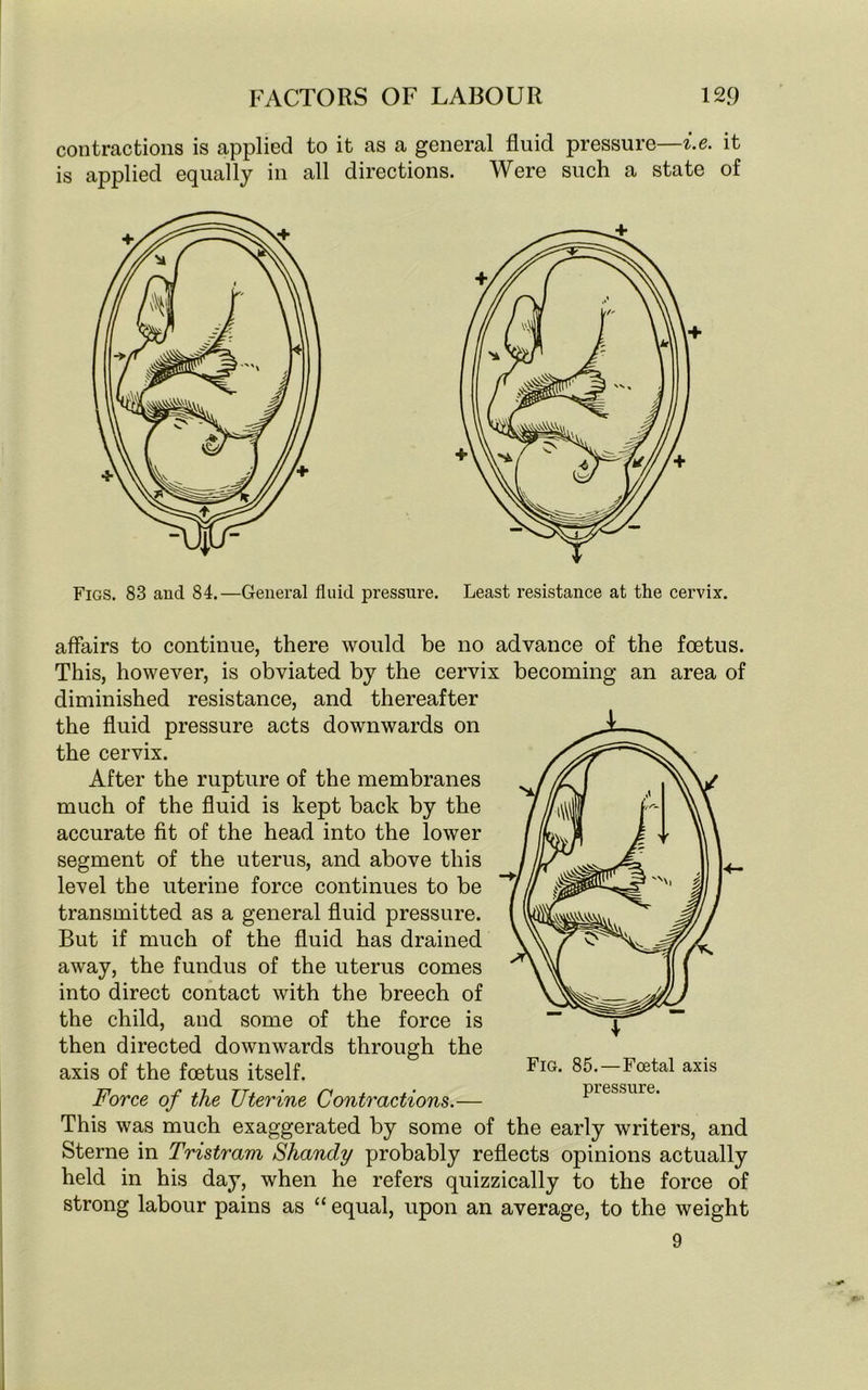 contractions is applied to it as a general fluid pressure—i.e. it is applied equally in all directions. Were such a state of Figs. 83 and 84.—General fluid pressure. Least resistance at the cervix. affairs to continue, there would be no advance of the foetus. This, however, is obviated by the cervix becoming an area of diminished resistance, and thereafter the fluid pressure acts downwards on the cervix. After the rupture of the membranes much of the fluid is kept back by the accurate fit of the head into the lower segment of the uterus, and above this level the uterine force continues to be transmitted as a general fluid pressure. But if much of the fluid has drained away, the fundus of the uterus comes into direct contact with the breech of the child, and some of the force is then directed downwards through the axis of the foetus itself. Force of the Uterine Contractions.— This was much exaggerated by some of the early writers, and Sterne in Tristram Shandy probably reflects opinions actually held in his day, when he refers quizzically to the force of strong labour pains as “ equal, upon an average, to the weight 9 Fig. 85. — Foetal axis pressure.