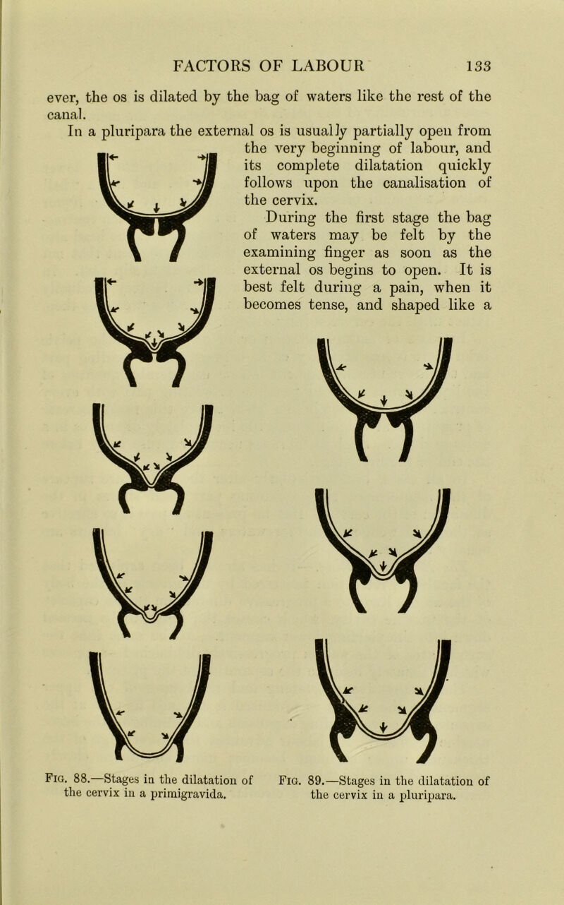 ever, the os is dilated by the bag of waters like the rest of the canal. In a pluripara the external os is usually partially open from the very beginning of labour, and its complete dilatation quickly follows upon the canalisation of the cervix. During the first stage the bag of waters may be felt by the examining finger as soon as the external os begins to open. It is best felt during a pain, when it becomes tense, and shaped like a Fio. 88.—Stages in the dilatation of the cervix in a primigravida. Fig. 89.—Stages in the dilatation of the cervix in a pluripara.