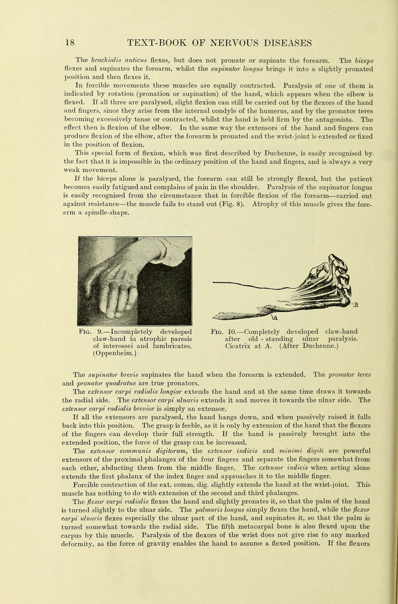 The hrachiulis anticus flexes, but does not pronate or supinate the forearm. The biceps flexes and supinates the forearm, whilst the supinator longus brings it into a slightly prouated position and then flexes it. In forcible movements these muscles are equally contracted. Paralysis of one of them is indicated by rotation (pronation or supination) of the hand, which appears when the elbow is flexed. If all three are paralysed, slight flexion can stiU be carried out by the flexors of the hand and fingers, since they arise from the internal condyle of the hiimerus, and by the pronator teres becoming excessively tense or contracted, whilst the hand is held firm by the antagonists. The effect then is flexion of the elbow. In the same way the extensors of the hand and fingers can produce flexion of the elbow, after the forearm is pronated and the wist-joint is extended or fixed in the position of fiexion. This special form of flexion, which was first described by Duchenne, is easily recognised by the fact that it is impossible in the ordinary position of the hand and fingers, and is always a very weak movement. If the biceps alone is paralysed, the forearm can still be strongly flexed, but the patient becomes easily fatigued and complains of pain in the shoulder. Paralysis of the supinator longus is easily recognised from the circumstance that in forcible flexion of the forearm—carried out against resistance—the muscle faUs to stand out (Fig. 8). Atrophy of this muscle gives the fore- arm a spindle-shape. The supinator brevis supinates the hand when the forearm is extended. The pronator teres and pronator quadratus are true pronators. The extensor carpi radialis longior extends the hand and at the same time draws it towards the radial side. The extensor carpi ulnaris extends it and moves it towards the ulnar side. The extensor carpi radialis brevior is simply an extensor. If all the extensors are paralysed, the hand hangs down, and when passively raised it falls back into this position. The grasp is feeble, as it is only by extension of the hand that the flexors of the fingers can develop their full strength. If the hand is passively brought into the extended position, the force of the grasp can be increased. Tlie extensor communis digitorum, the extensor indicis and minimi digiti are powerful extensors of the proximal phalanges of the four fingers and separate the fingers somewhat from each other, abducting them from the middle finger. The extensor indicis when acting alone extends the first phalanx of the index finger and approaches it to the middle finger. Forcible contraction of the ext. comm. dig. slightly extends the hand at the wist-joint. This muscle has nothing to do with extension of the second and thii-d jahalanges. The flexor carpi radialis flexes the hand and slightly pronates it, so that the palm of the hand is turned slightly to the ulnar side. The palmaris longus simply flexes the hand, while the flexor carpi ulnaris flexes especially the ulnar part of the hand, and supinates it, so that the palm is turned somewhat towards the radial side. The fifth metacarpal bone is also flexed upon the carpus by this muscle. Paralysis of the flexors of the wrist does not give rise to any marked deformity, as the force of gravity enables the hand to assume a flexed position. If the flexors Fig. 9.—Incompletely developed claw-hand in atrophic paresis of interossei and lumbricates. (Oppenheim.) Fig. 10.—Completely developed claw-hand after old - standing ulnar paralysis. Cicatrix at A. (After Duchenne.)