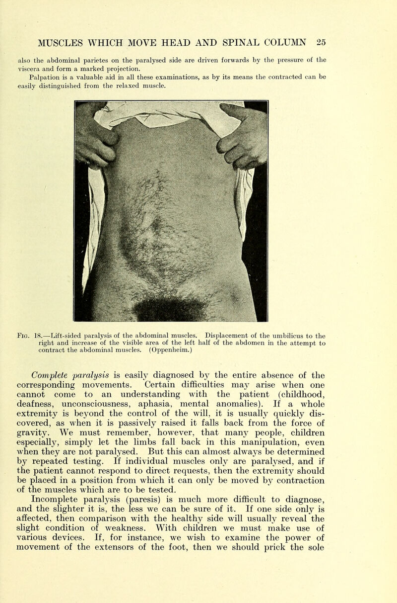 also the abdominal parietes on the paralysed side are driven forwards by the pressure of the viscera and form a marked projection. Palpation is a valuable aid in all these examinations, as by its means the contracted can be easily distinguished from the relaxed muscle. Fig. 18.—Lift-sided paralysis of the abdominal muscles. Displacement of the umbilicus to the right and increase of the visible area of the left half of the abdomen in the attempt to contract the abdominal muscles. (Oppenheim.) Complete paralysis is easily diagnosed by the entire absence of the corresponding movements. Certain diflficiilties may arise when one cannot come to an understanding with the patient (childhood, deafness, unconsciousness, aphasia, mental anomalies). If a whole extremity is beyond the control of the will, it is usually quickly dis- covered, as when it is passively raised it falls back from the force of gravity. We must remember, however, that many people, children especially, simply let the limbs fall back in this manipulation, even when they are not paralysed. But this can almost always be determined by repeated testing. If individual muscles only are parah'sed, and if the patient cannot respond to direct requests, then the extremity should be placed in a position from which it can only be moved by contraction of the muscles which are to be tested. Incomplete paralysis (paresis) is much more difficult to diagnose, and the slighter it is, the less we can be sure of it. If one side only is affected, then comparison with the healthy side will usually reveal the slight condition of weakness. With children we must make use of various devices. If, for instance, we wish to examine the power of movement of the extensors of the foot, then we should prick the sole