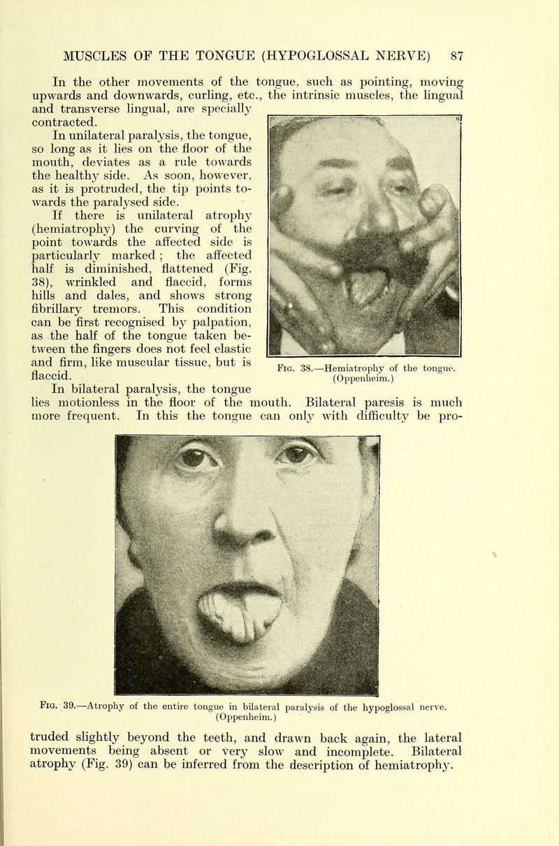 In the other movements of the tongue, such as pointing, moving upwards and downwards, curHng, etc and transverse hngual, are specially contracted. In unilateral paralysis, the tongue, so long as it lies on the floor of the mouth, deviates as a rule towards the healthy side. As soon, however, as it is protruded, the tip points to- wards the paralysed side. If there is unilateral atrophy (hemiatrophy) the curving of the point towards the affected side is particularly marked ; the affected half is diminished, flattened (Fig. 38), wrinkled and flaccid, forms hills and dales, and shows strong fibrillary tremors. This condition can be first recognised by palpation, as the half of the tongue taken be- tween the fingers does not feel elastic and firm, like muscular tissue, but is flaccid. In bilateral paralysis, the tongue lies motionless in the floor of the mouth more frequent the intrinsic muscles, the lingual Feg. 38.—Hemiatrophy of tlie tongue. (Oppenheim.) Bilateral paresis is much In this the tongue can only with difficulty be pro- FlG. 39.—Atrophy of the entire tongue in bUateral paralysis of the hypoglossal nerve. (Oppenheim.) truded slightly beyond the teeth, and drawn back again, the lateral movements being absent or very slow and incomplete. Bilateral atrophy (Fig. 39) can be inferred from the description of hemiatrophy.