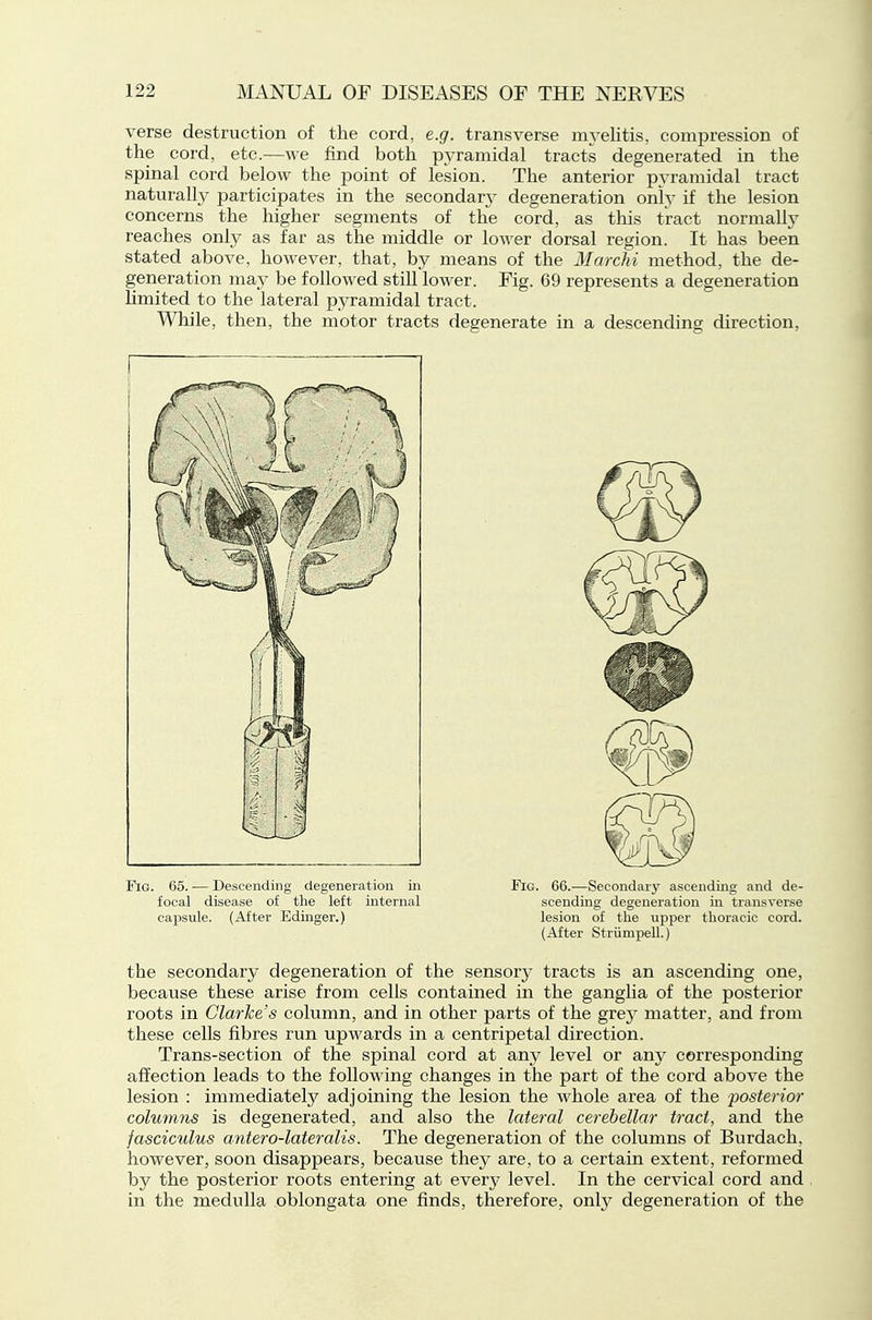 verse destruction of the cord, e.g. transverse m3'elitis, compression of the cord, etc.—we find both pyramidal tracts degenerated in the spinal cord below the point of lesion. The anterior pyramidal tract natural^ participates in the secondary'- degeneration only if the lesion concerns the higher segments of the cord, as this tract normally reaches only as far as the middle or lower dorsal region. It has been stated above, however, that, by means of the Marchi method, the de- generation may be followed stiU lower. Fig. 69 represents a degeneration Kmited to the lateral pyramidal tract. While, then, the motor tracts degenerate in a descending direction, Fig. 65. — Descending degeneration in Fig. 66.—Secondary ascending and de- focal disease of the left internal scending degeneration in transverse capsule. (After Edinger.) lesion of the upper thoracic cord. (After Striimpell.) the secondary degeneration of the sensorj' tracts is an ascending one, because these arise from cells contained in the ganglia of the posterior roots in Clarke's column, and in other parts of the gvey matter, and from these cells fibres run upwards in a centripetal direction. Trans-section of the spinal cord at any level or any corresponding affection leads to the following changes in the part of the cord above the lesion : immediately adjoining the lesion the whole area of the 'posterior columns is degenerated, and also the lateral cerebellar tract, and the fasciculus antero-lateralis. The degeneration of the columns of Burdach, however, soon disappears, because they are, to a certain extent, reformed by the posterior roots entering at every level. In the cervical cord and in the medulla oblongata one finds, therefore, only degeneration of the
